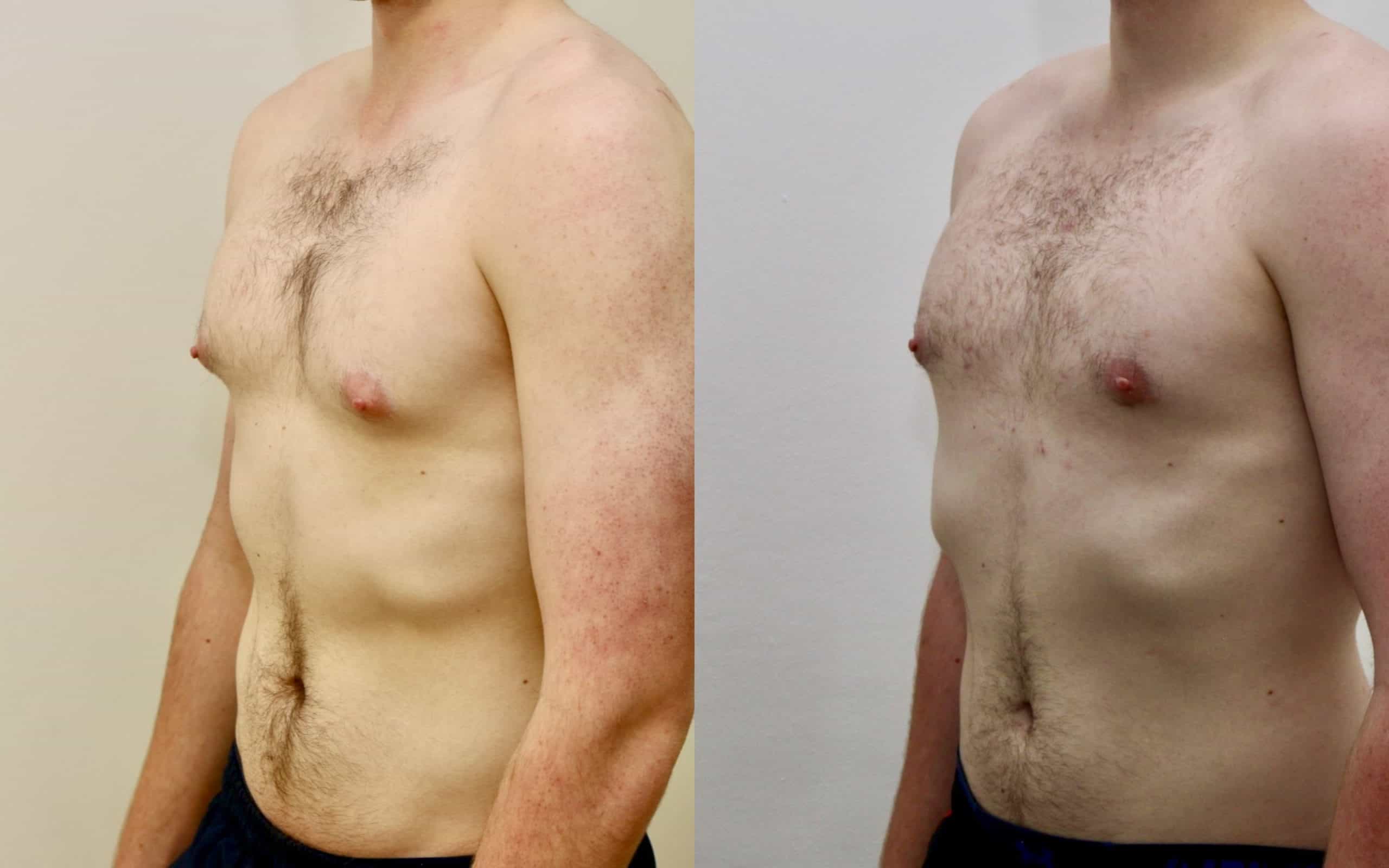 Gynecomastia liposuction and gland excision before and after