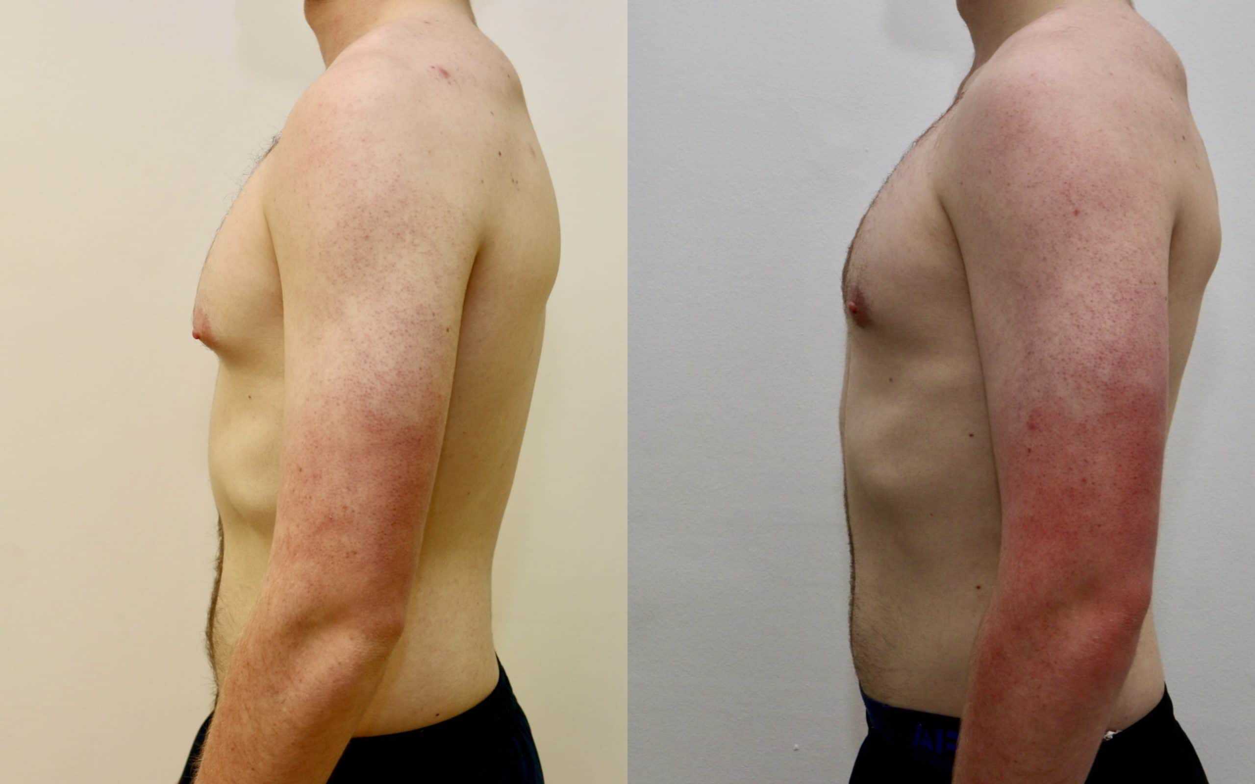 Gynecomastia liposuction and gland excision before and after