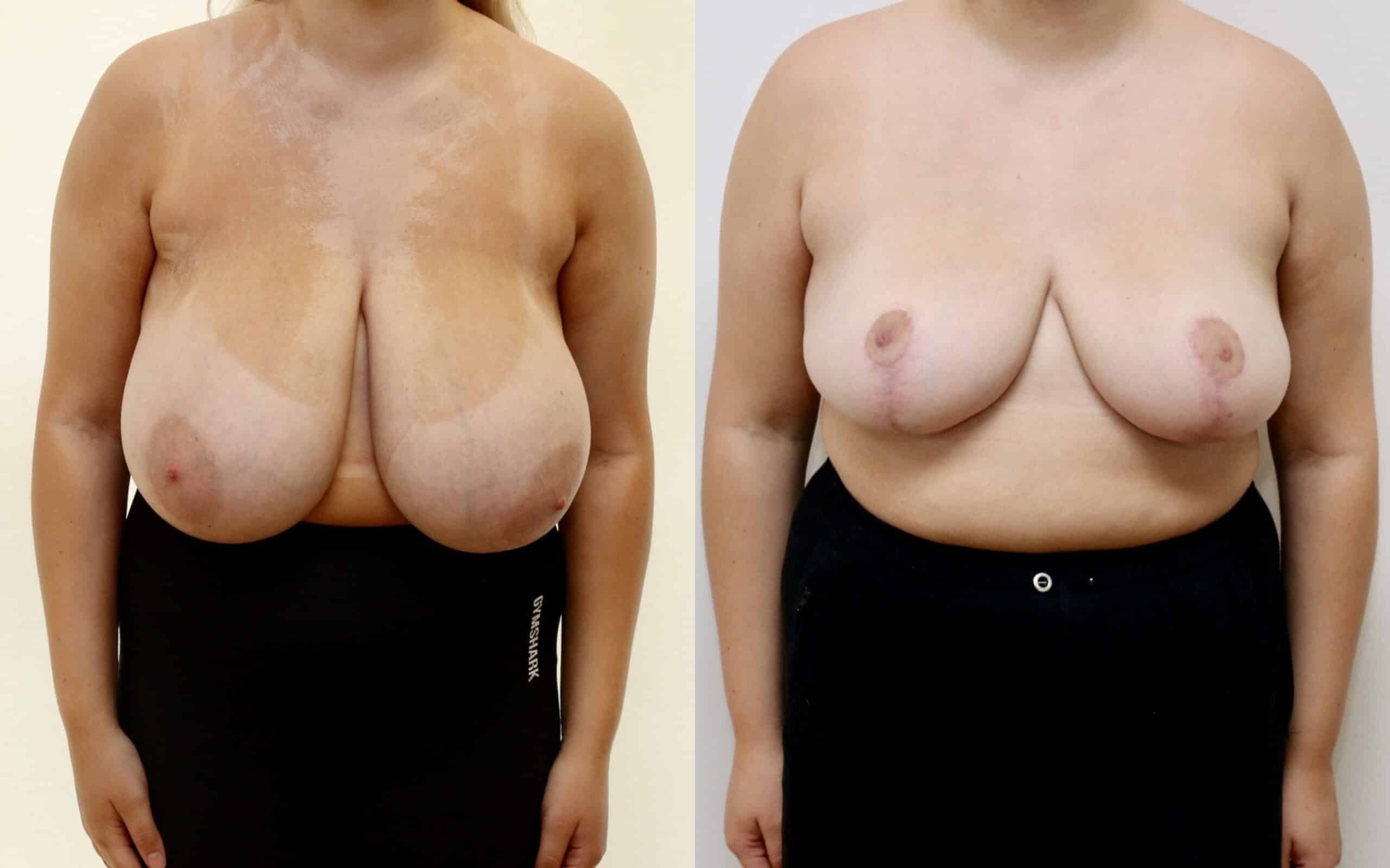 breast reduction scotland