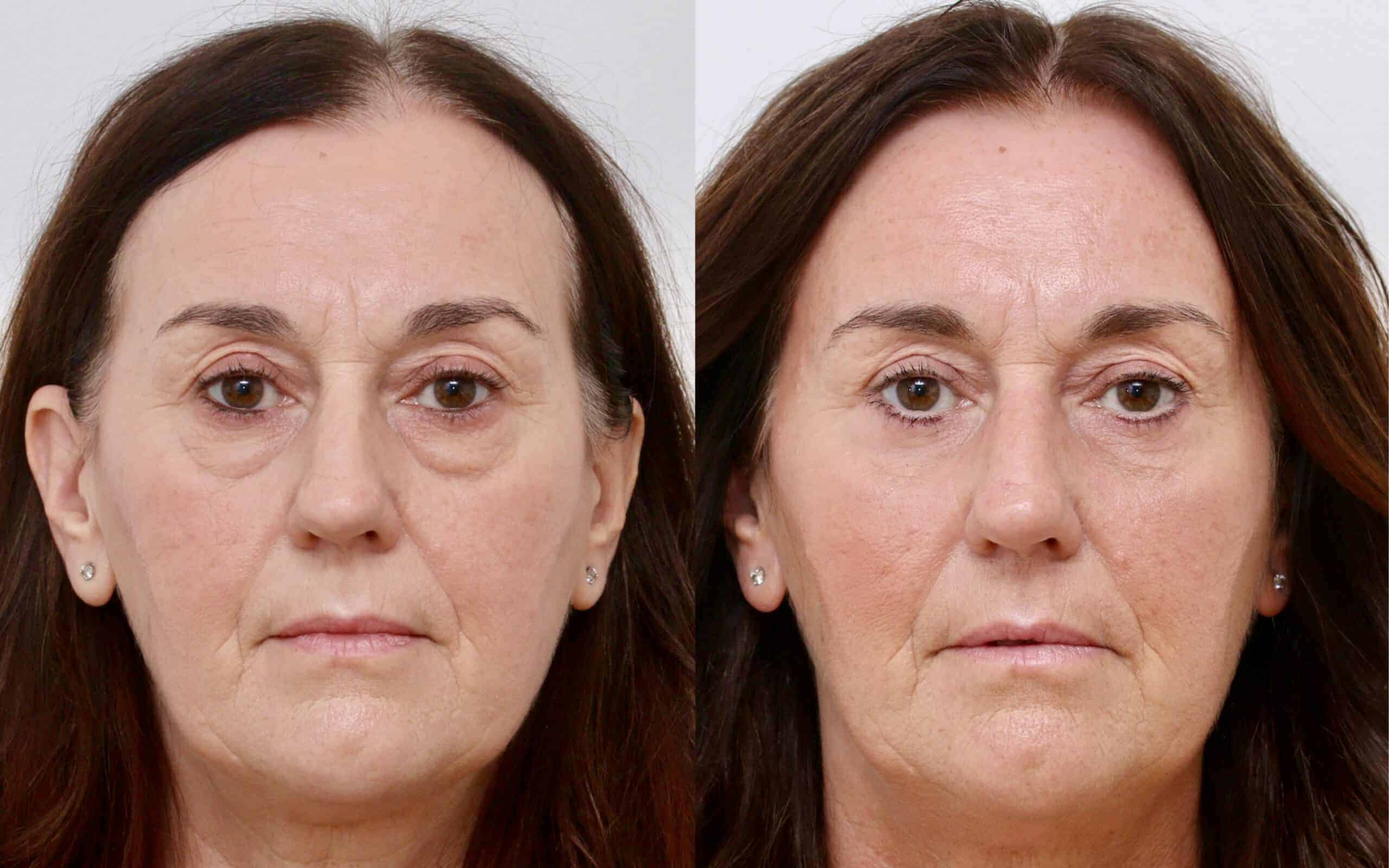 eyelid surgery UK