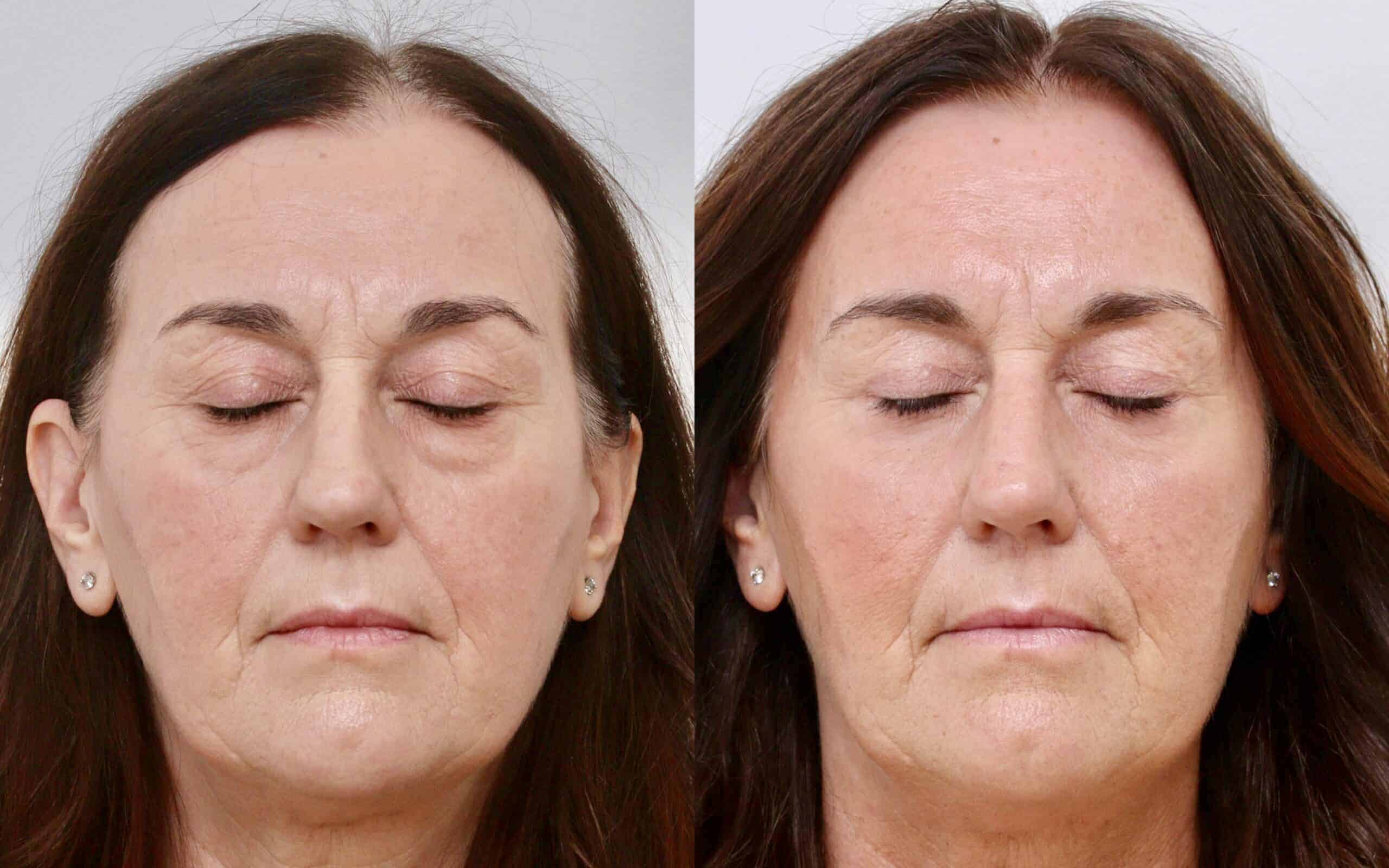 Upper and lower blepharoplasty