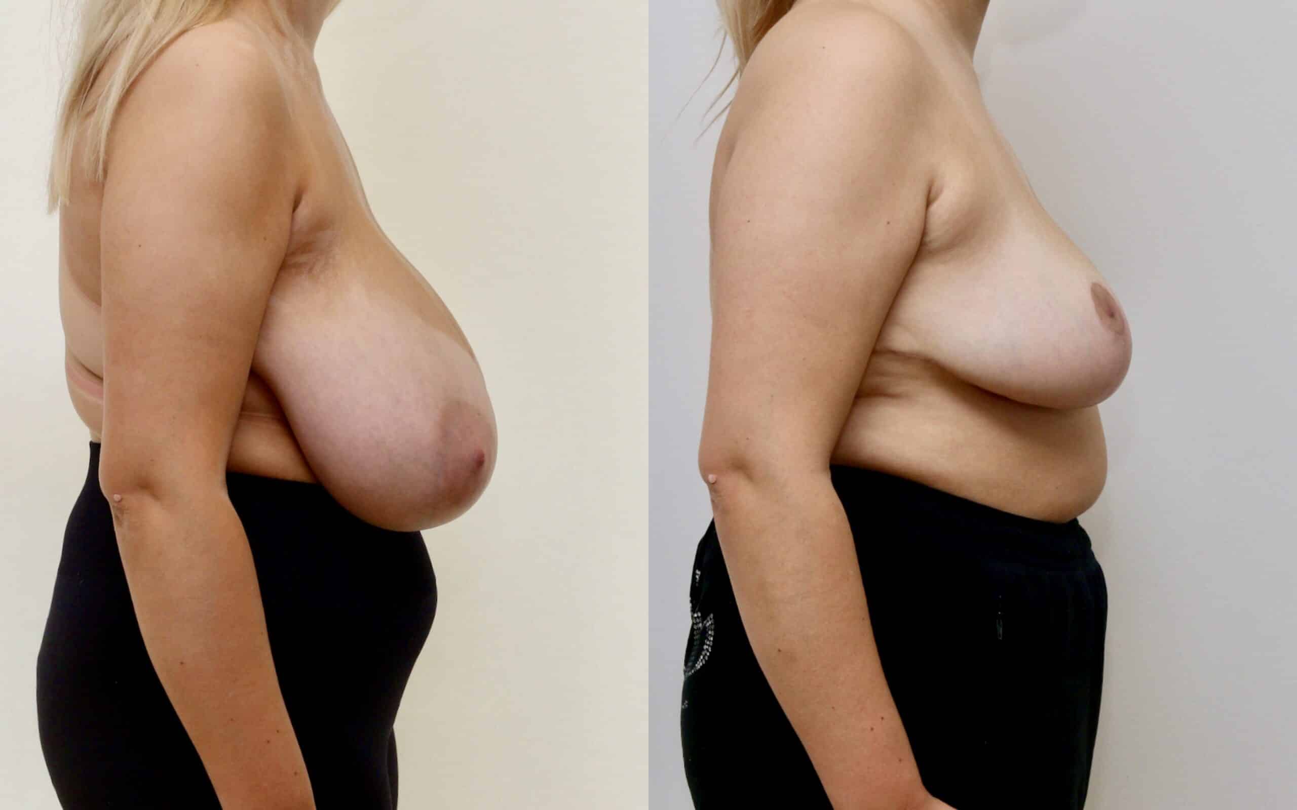 breast reduction before and after