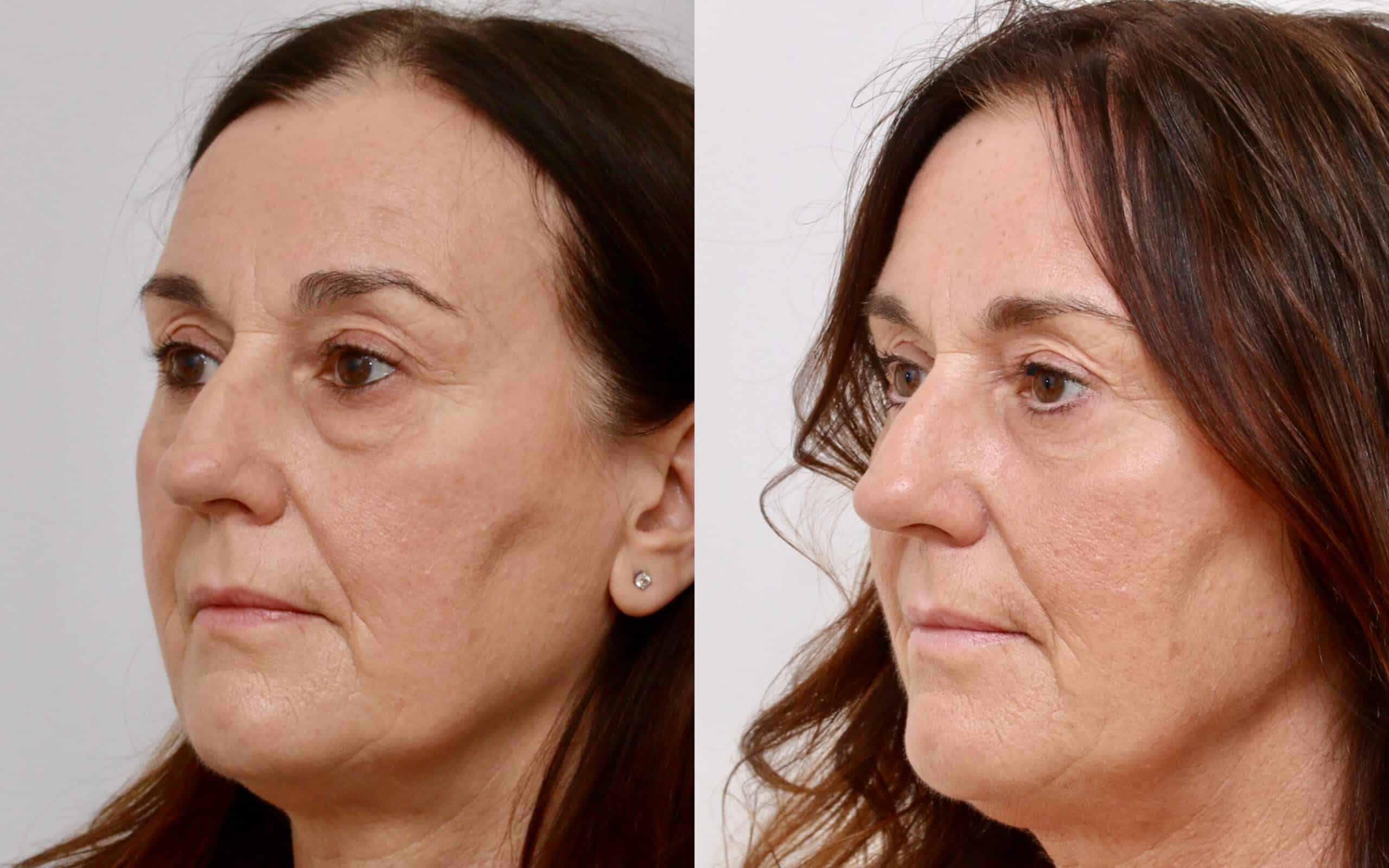 Upper and lower blepharoplasty