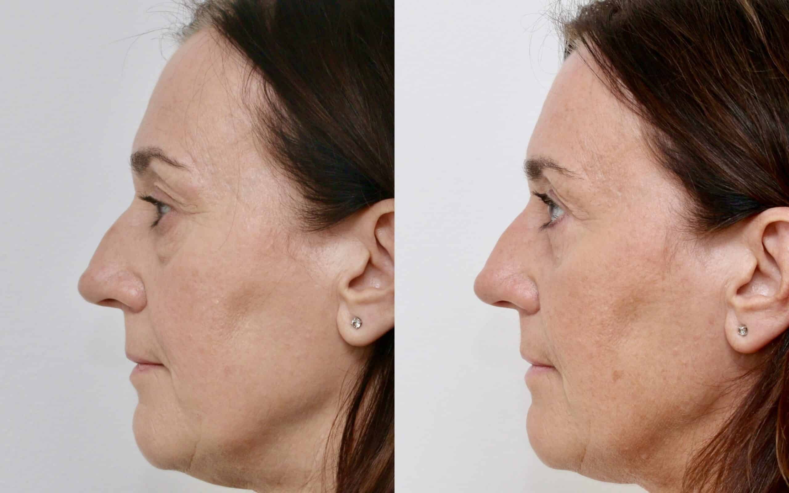 Upper and lower blepharoplasty