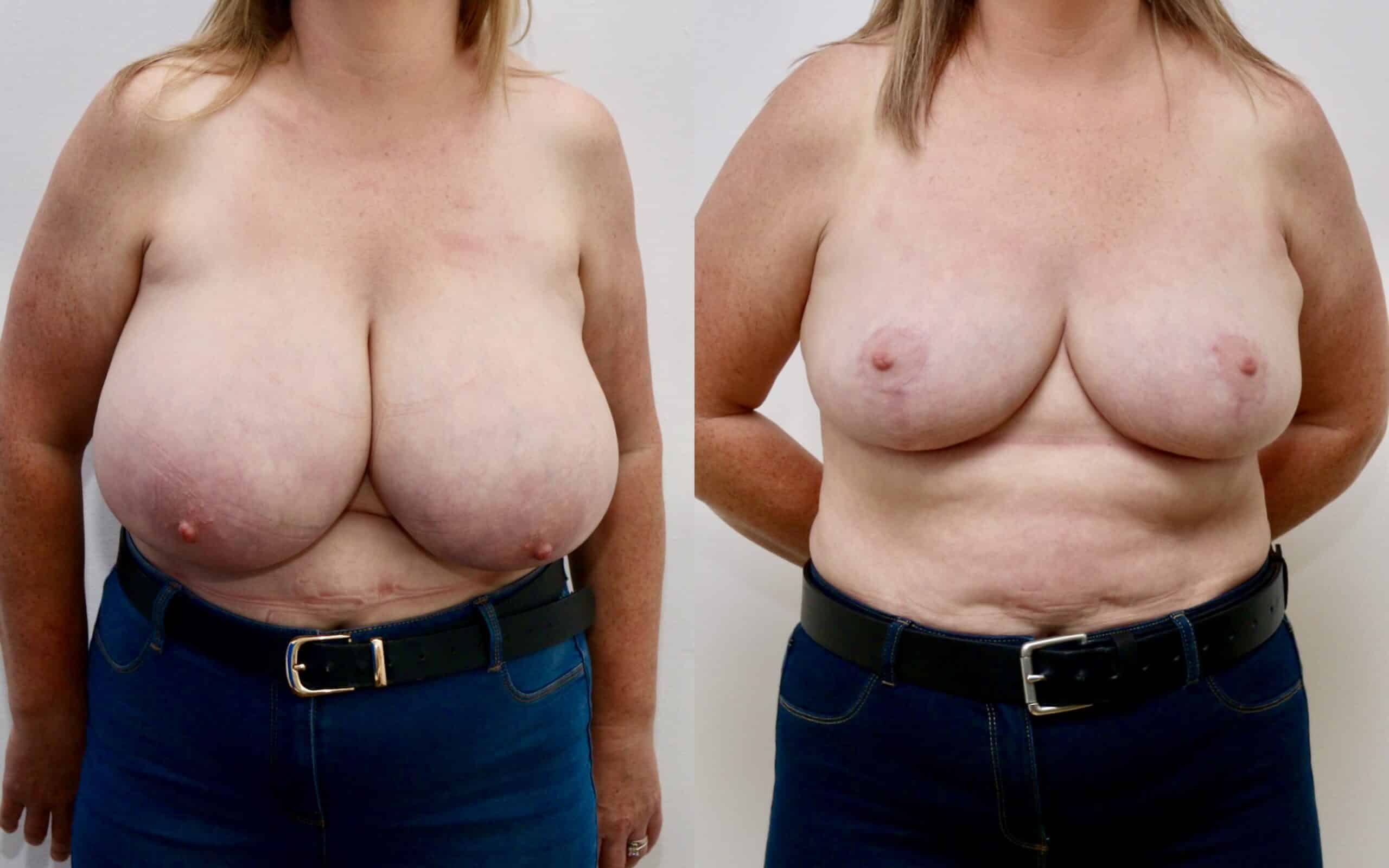 breast reduction before and after