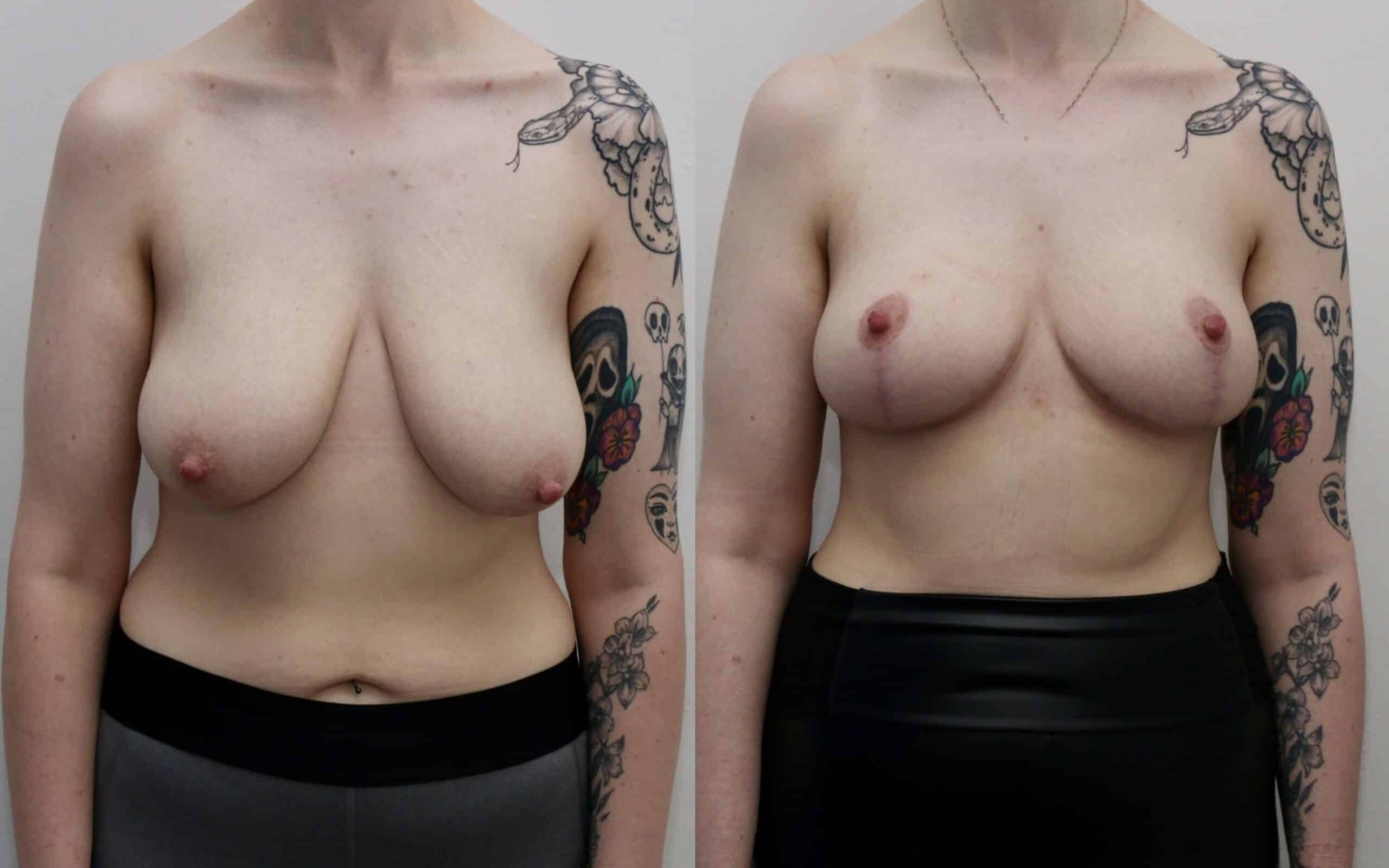 breast uplift before and after uk