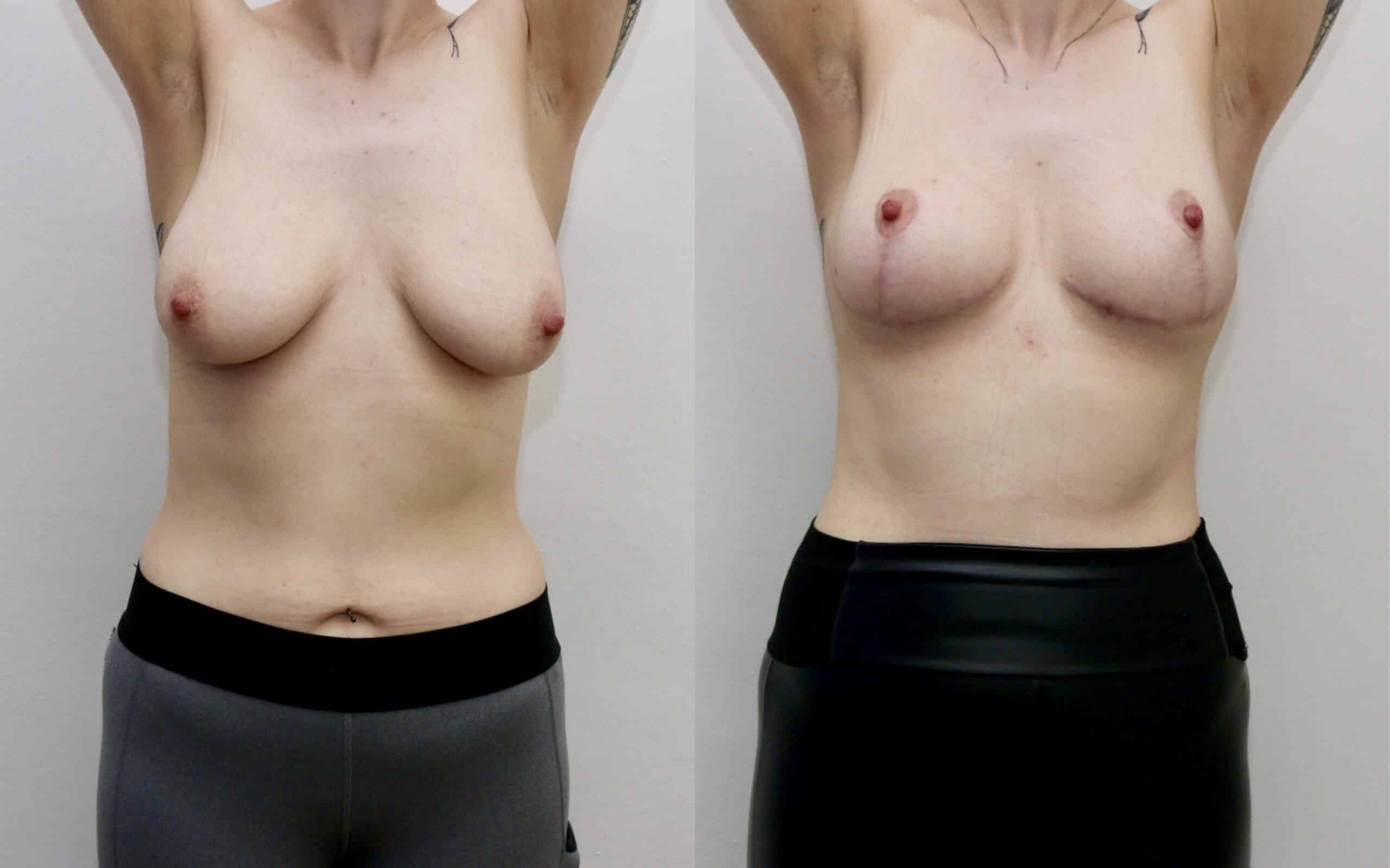 Breast uplift skin only