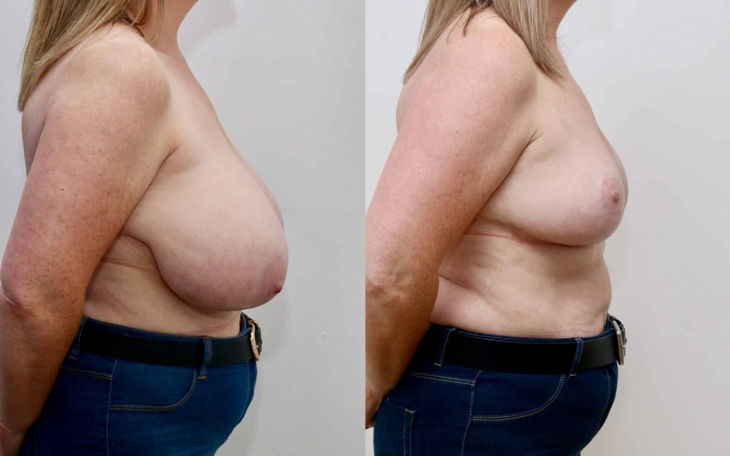 breast reduction scotland