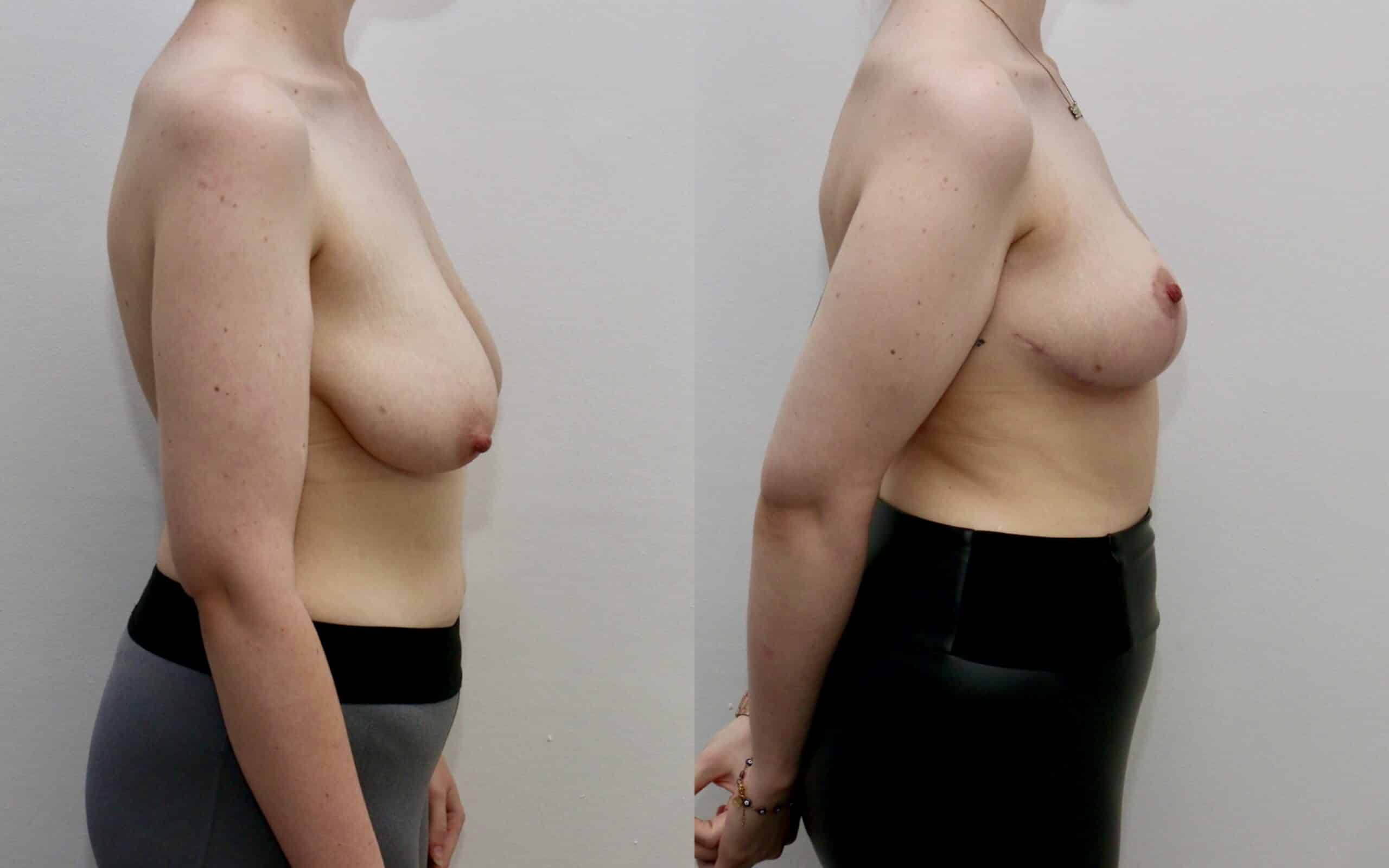 Breast uplift skin only