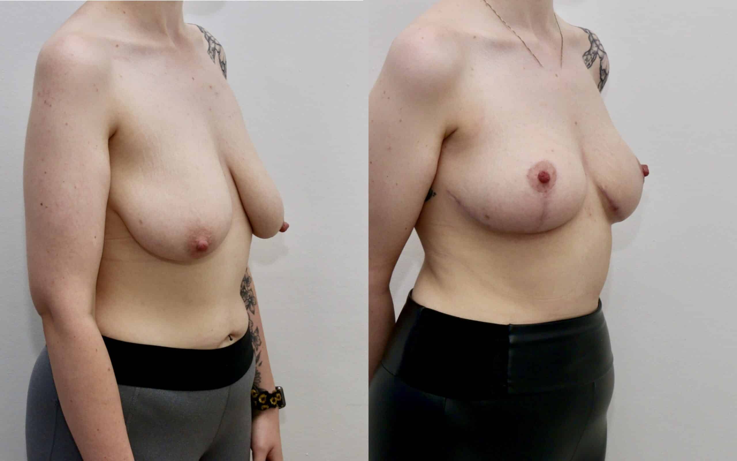 breast uplift before and after