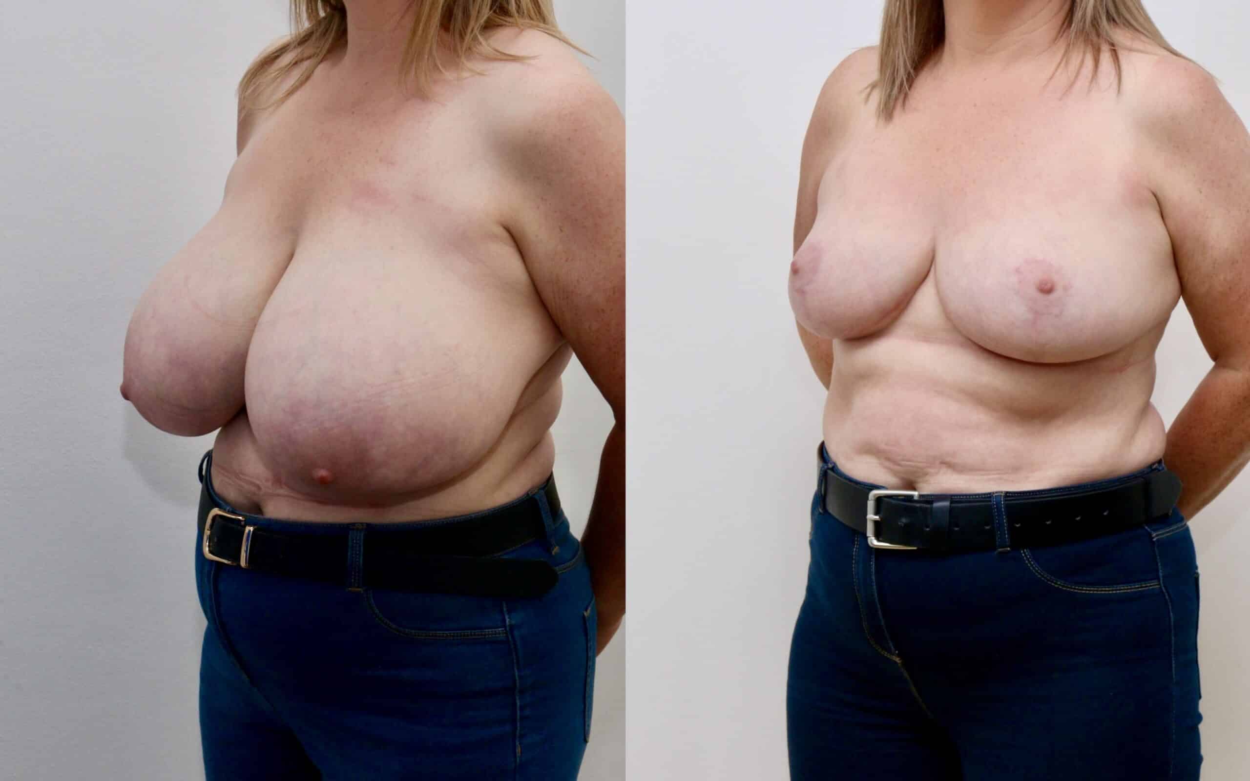 Breast reduction