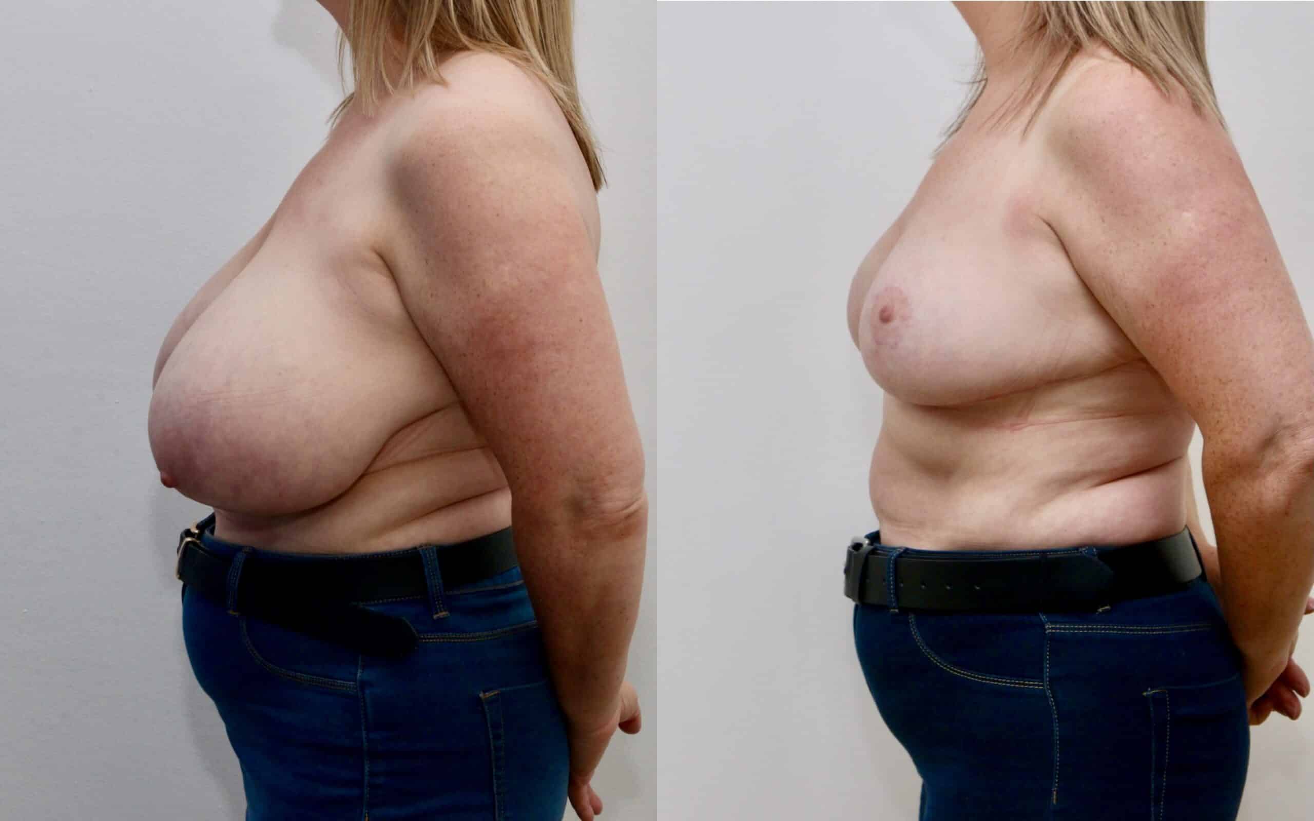 Breast reduction