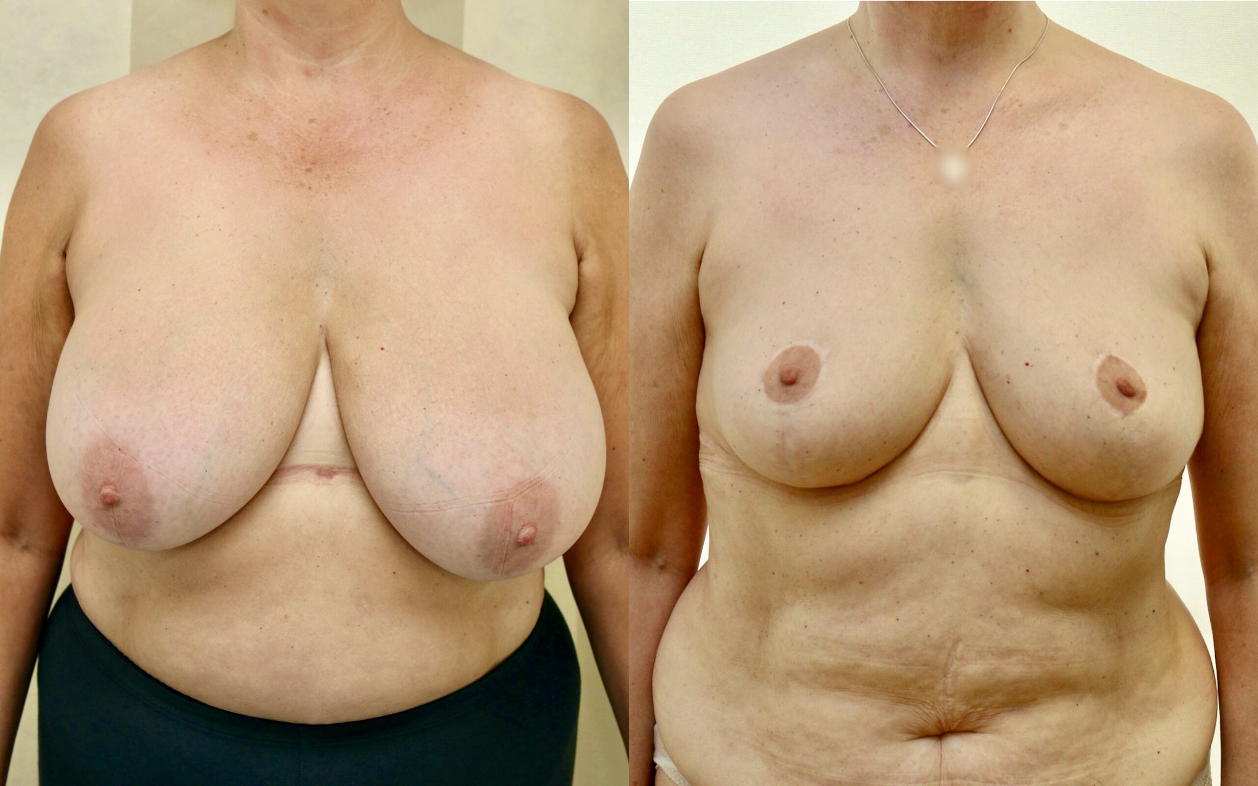 Breast reduction 6 months and 3 years