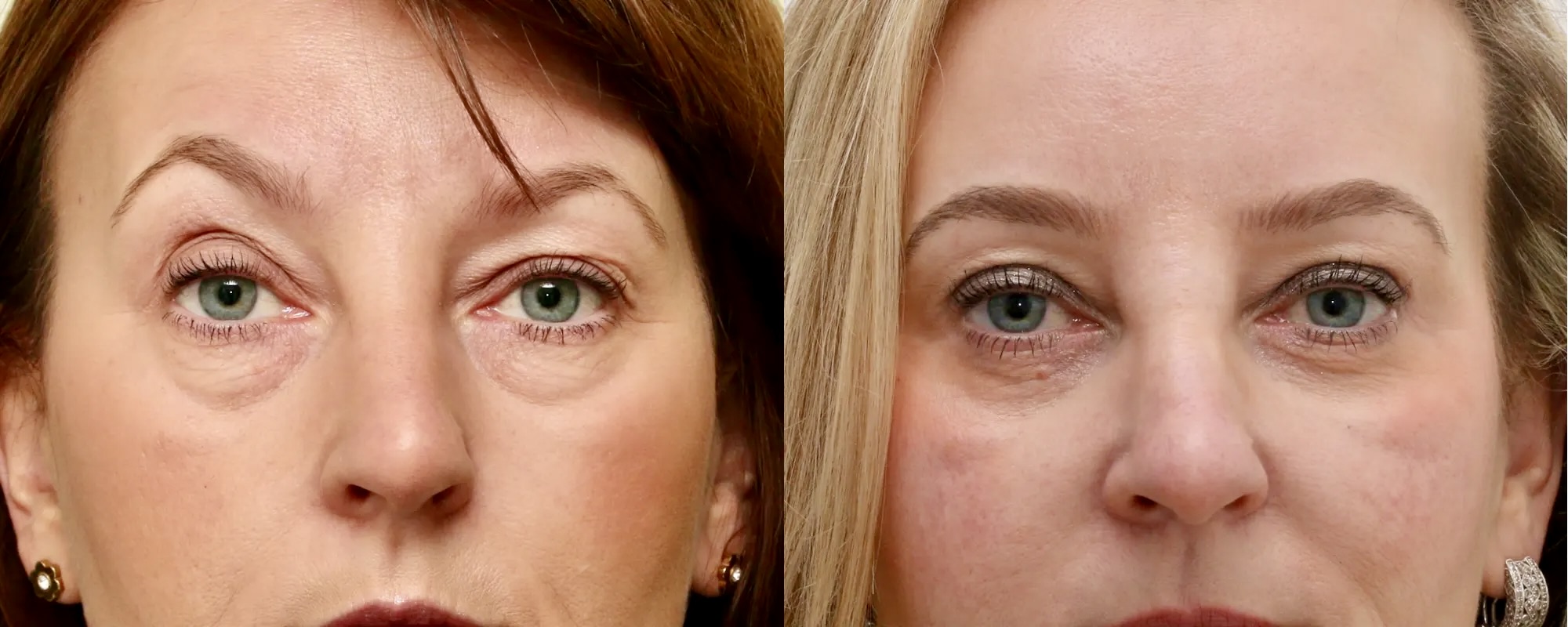 Lower and upper eyelid surgery with fat transfer