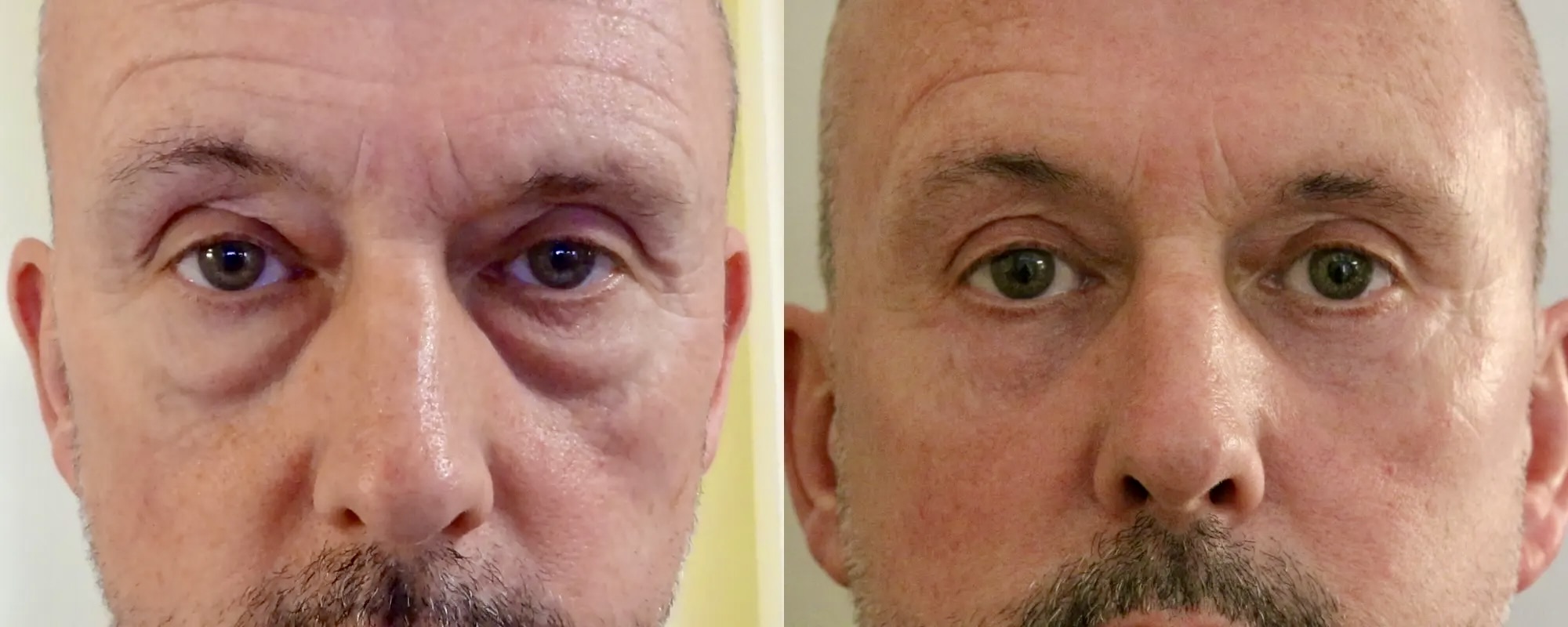 Upper and lower eyelid surgery with fat transfer