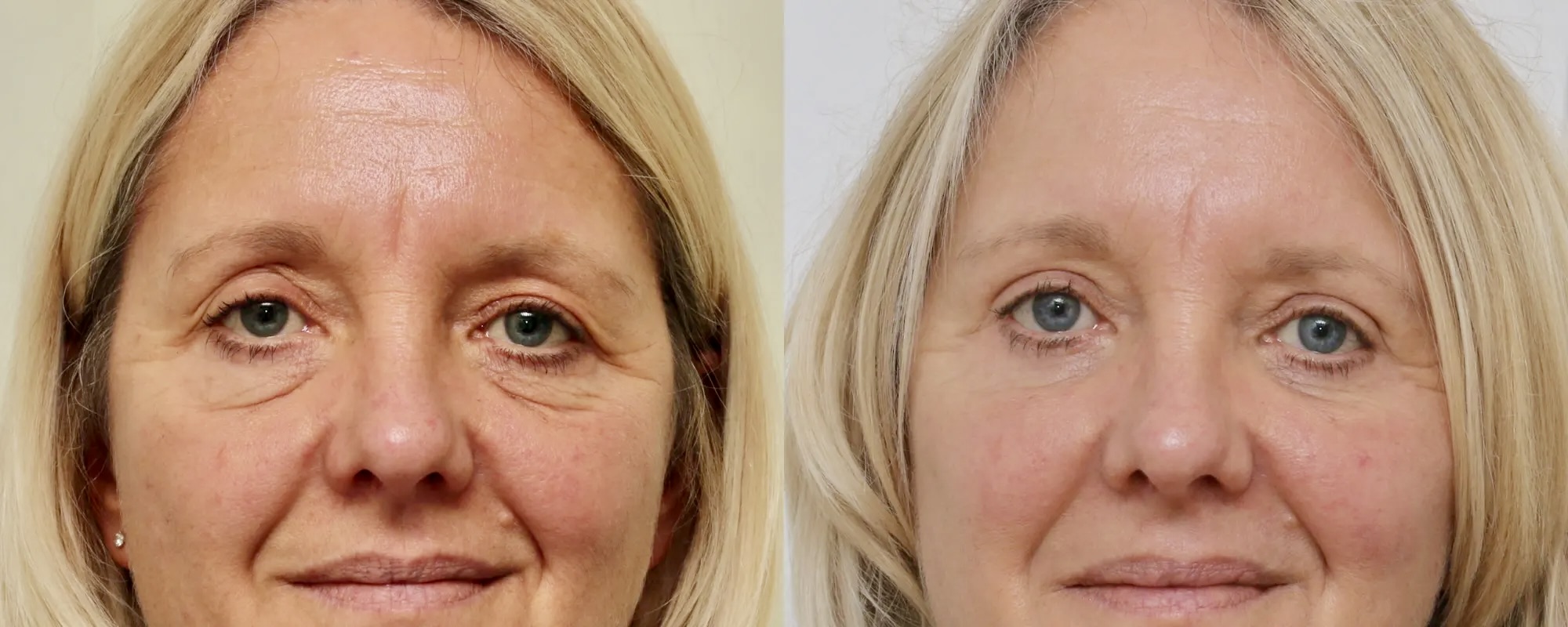 Upper and lower eyelid surgery