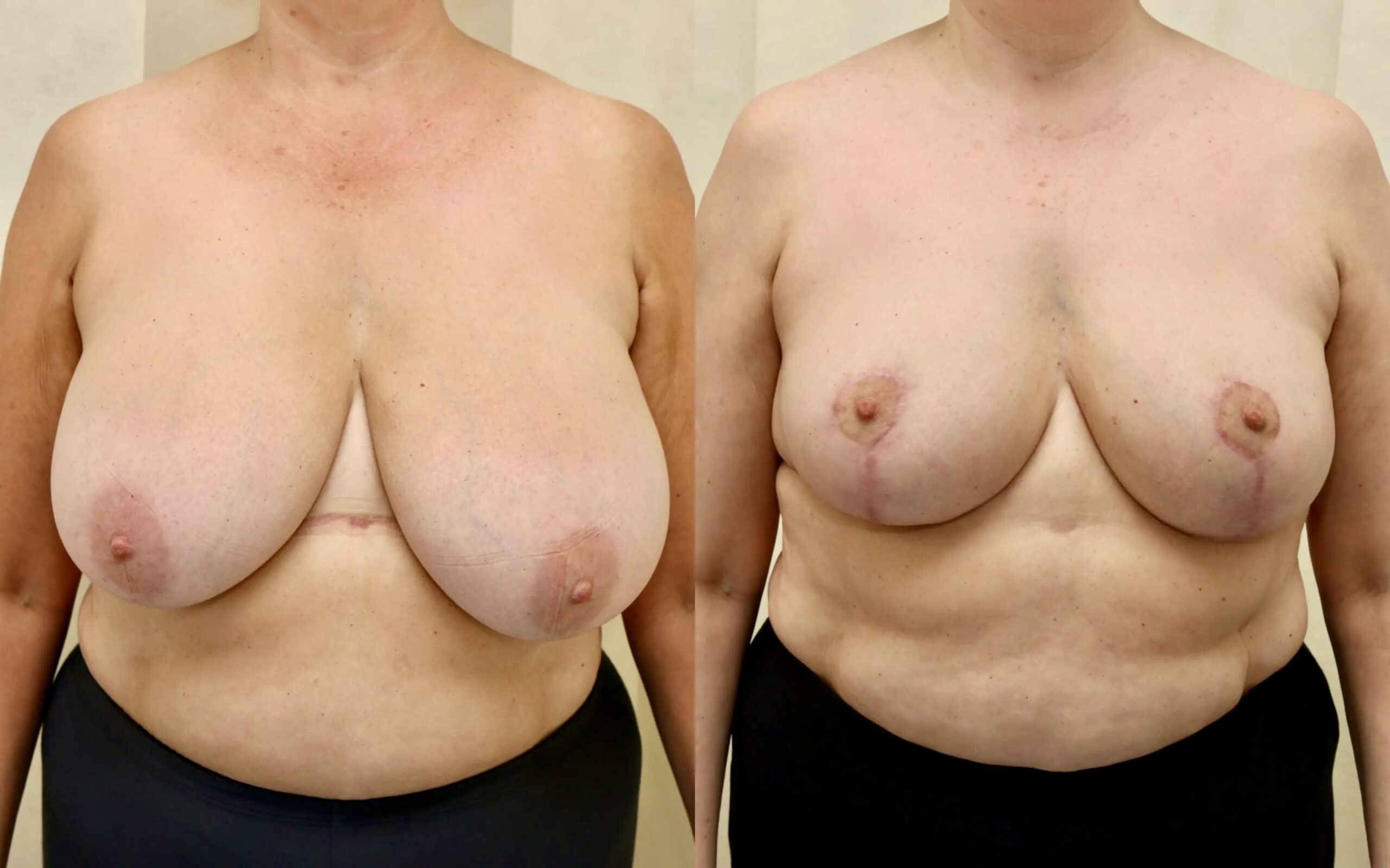 long terms after breast reduction