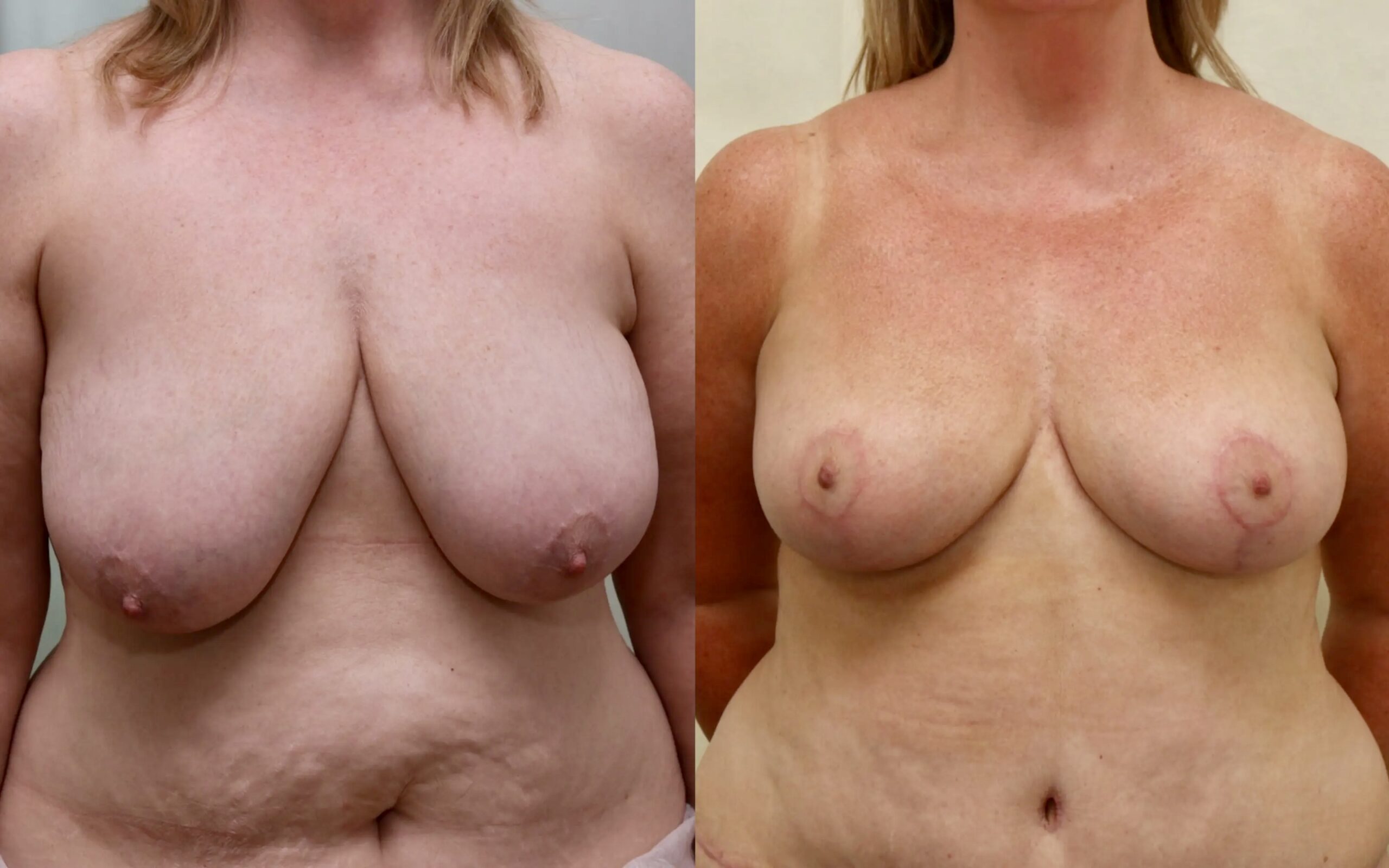 Breast reduction before and after - asymmetry
