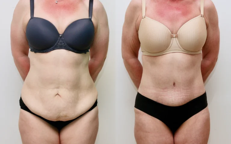 Tummy tuck drainless before and after, photo 1 of 5