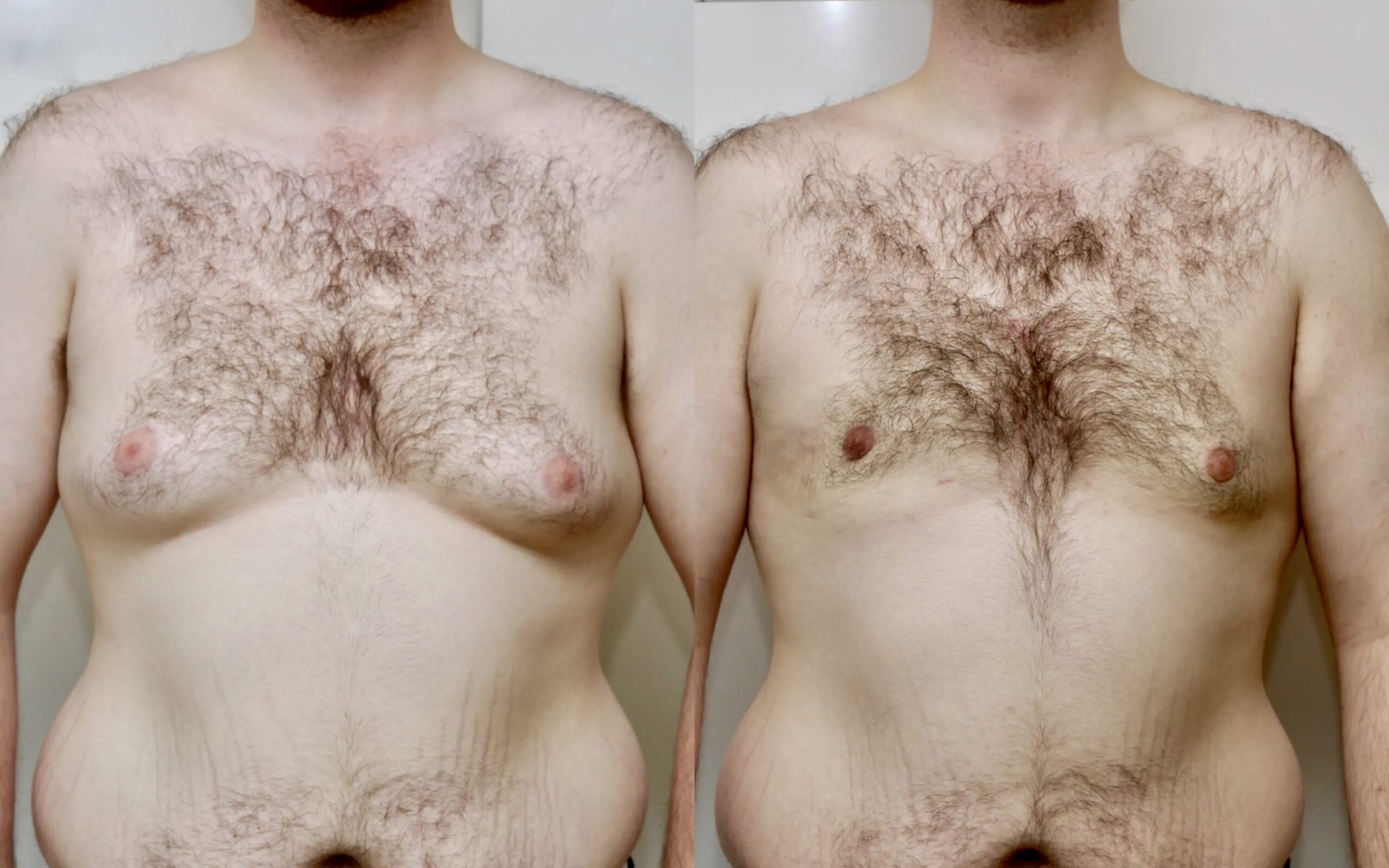 Male breast reduction before and after