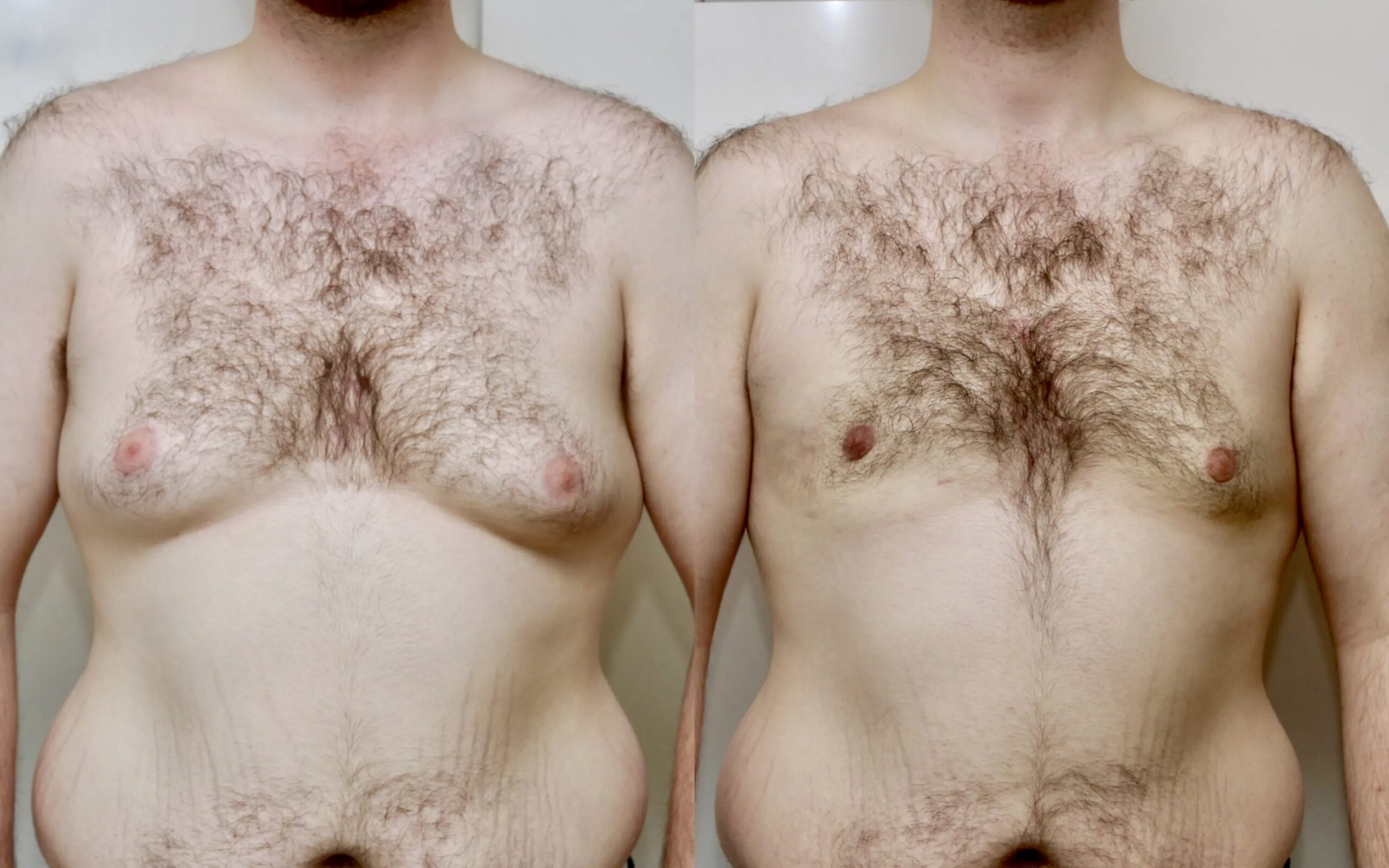 Male breast reduction before and after