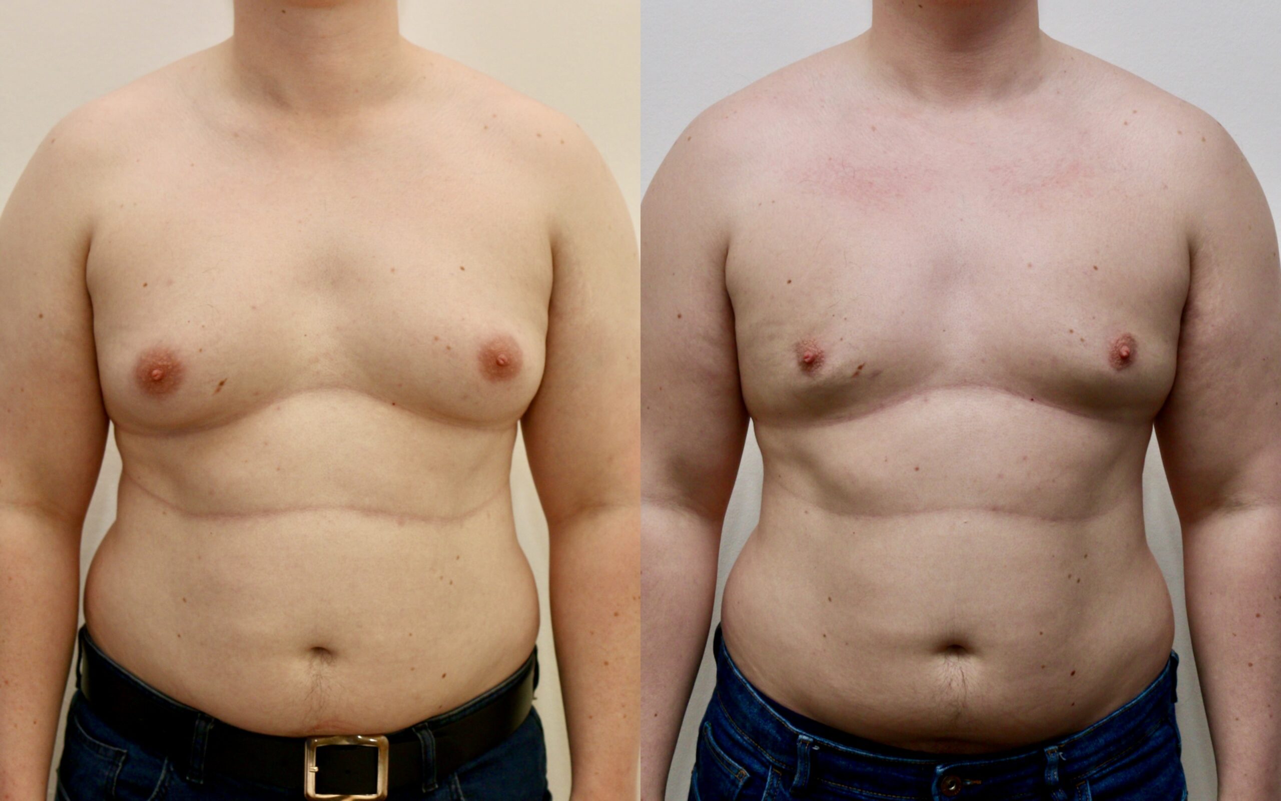 high volume lipo to correct gynecomastia