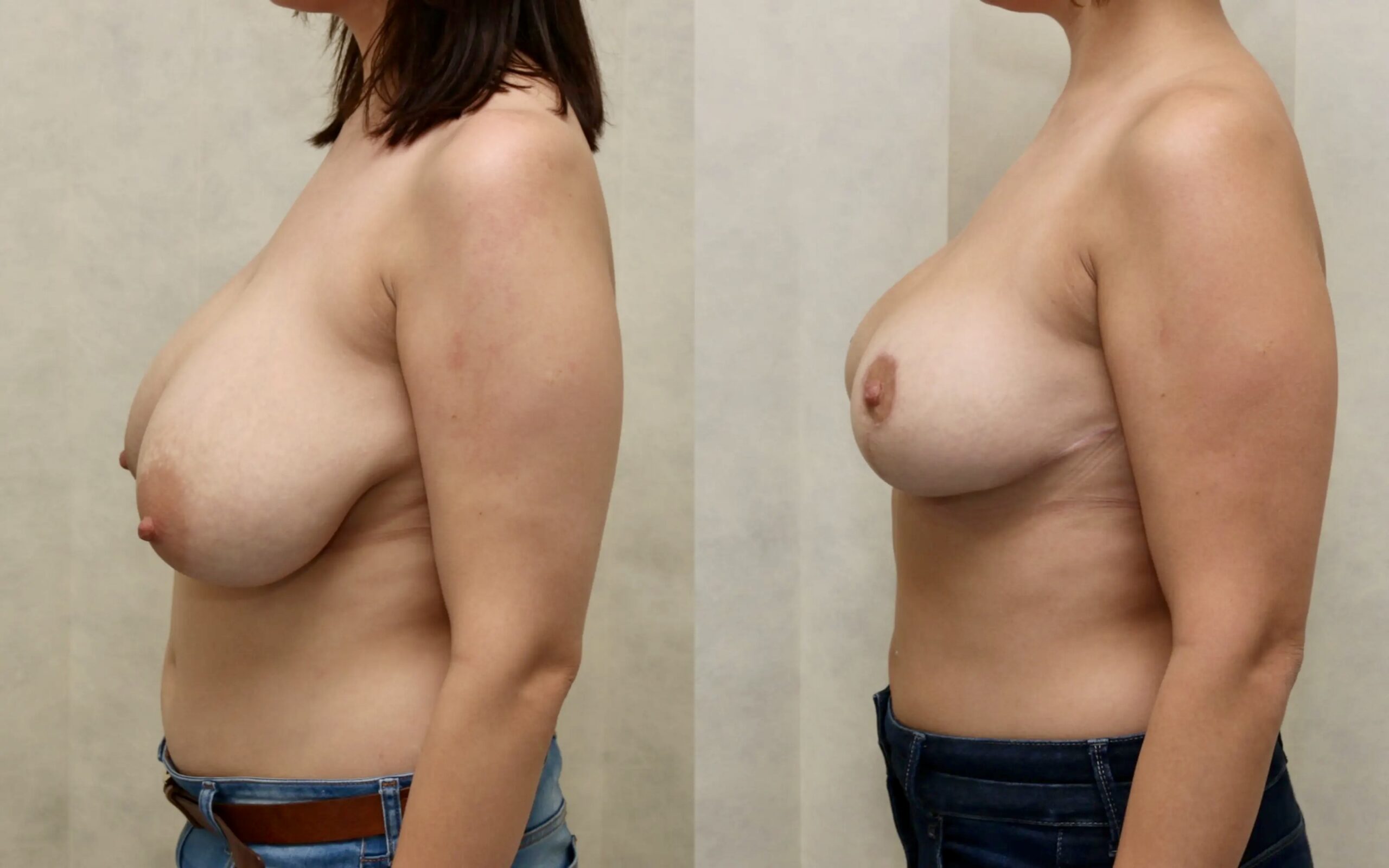 Breast reduction results at four weeks and six months