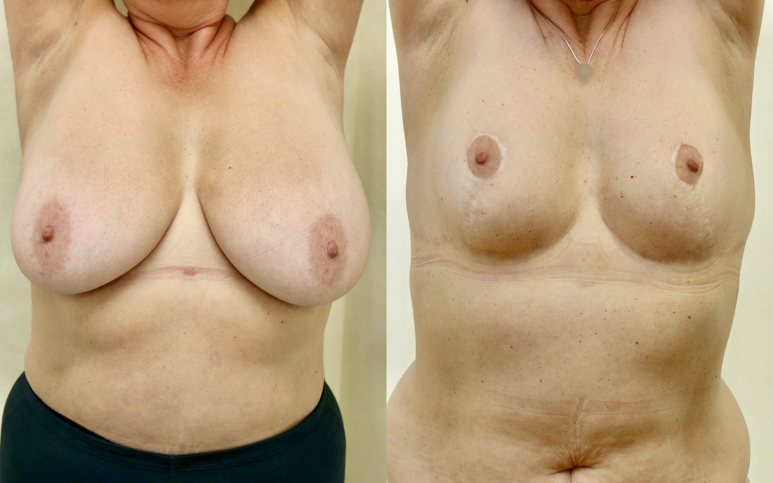 Breast reduction 6 months and 3 years