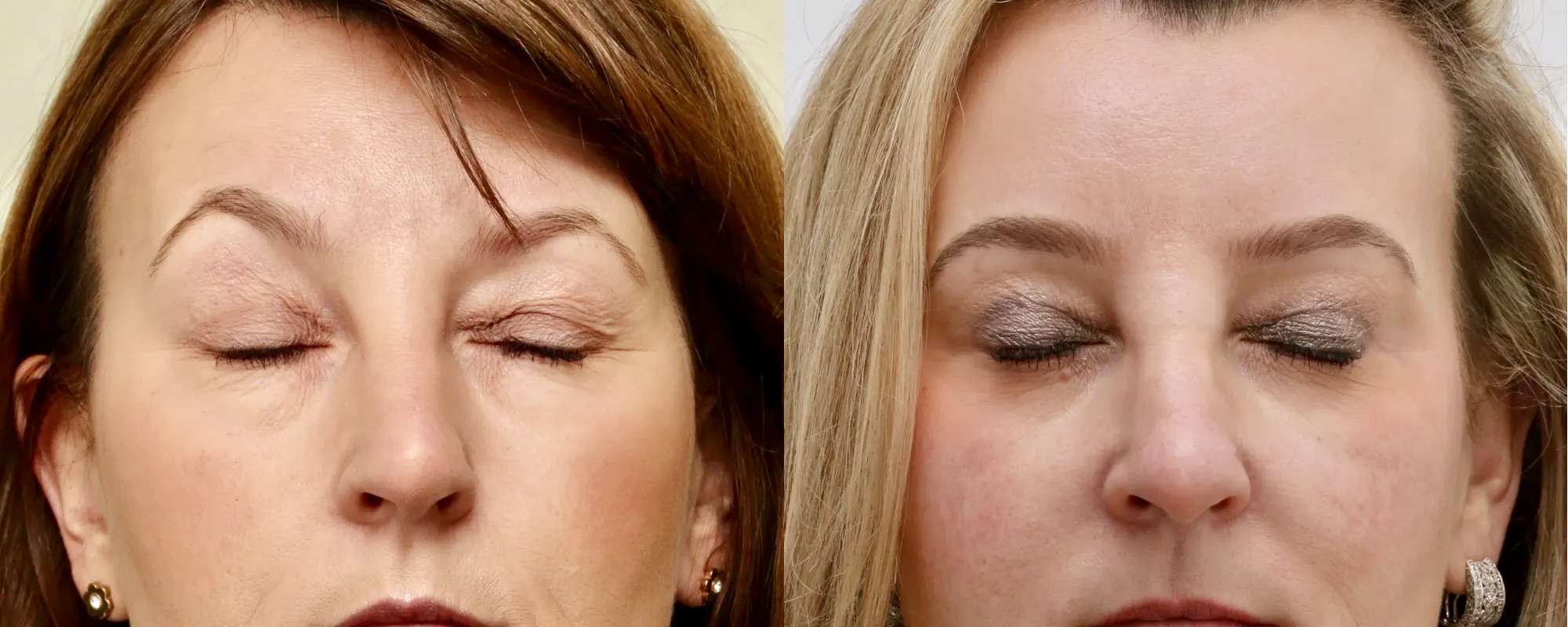 Lower and upper eyelid surgery with fat transfer