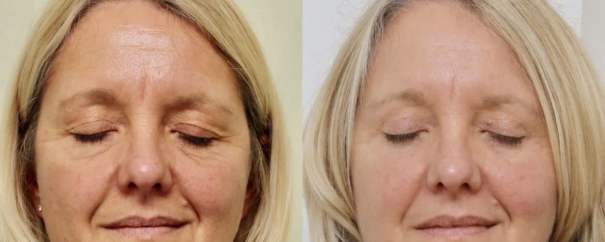 Upper and lower eyelid surgery