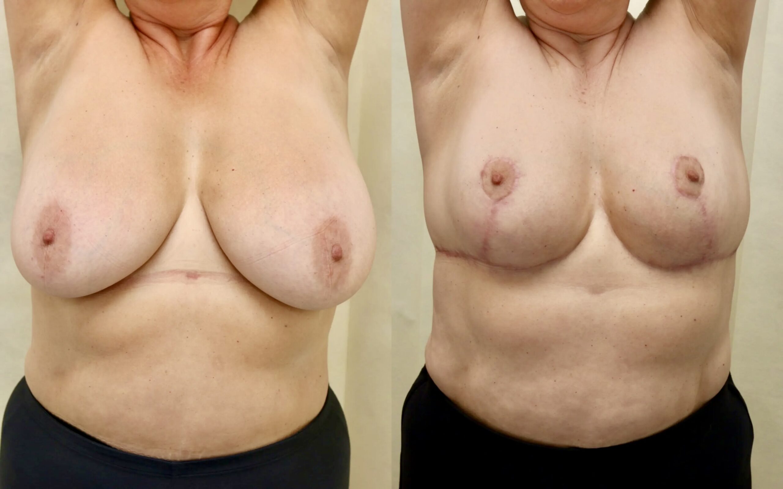 Breast reduction 6 months and 3 years