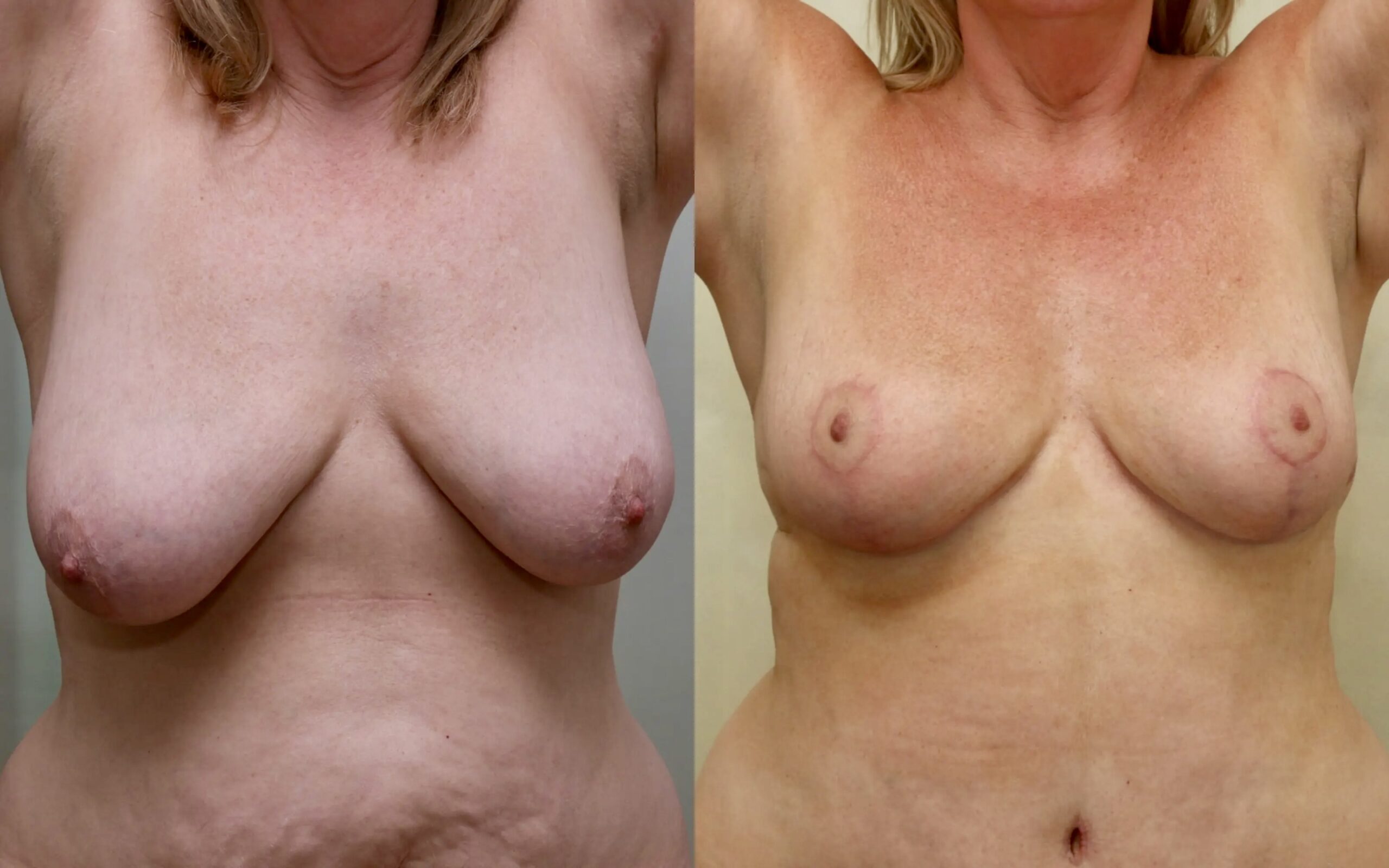 Breast lift/ reduction