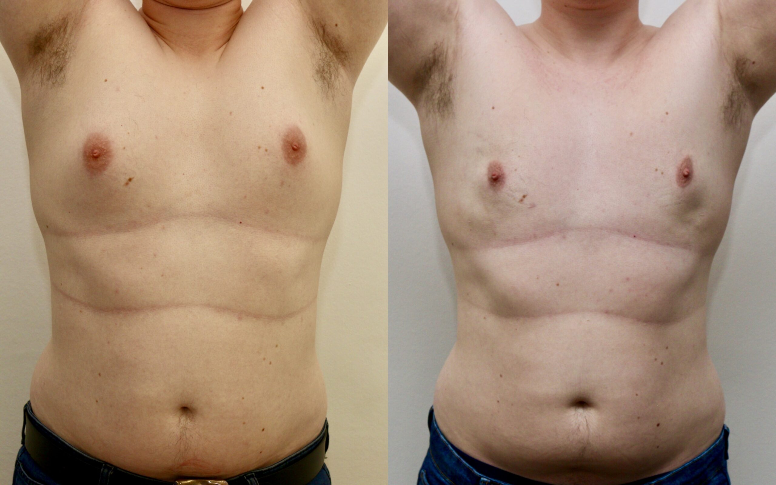 Gynaecomastia before and after