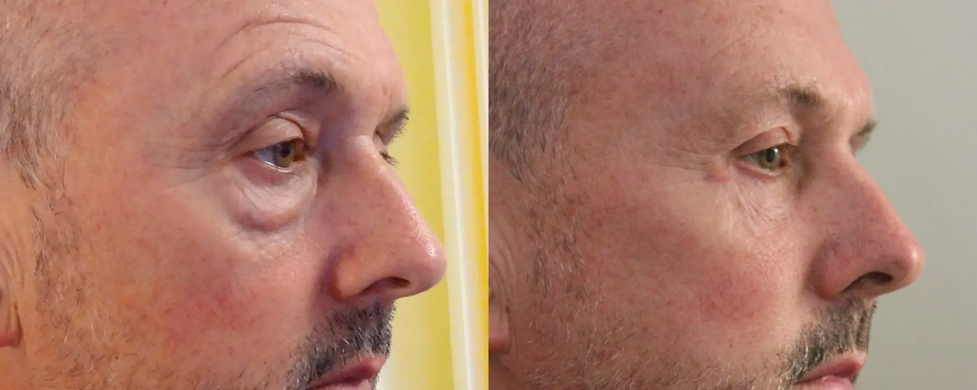 Upper and lower eyelid surgery with fat transfer