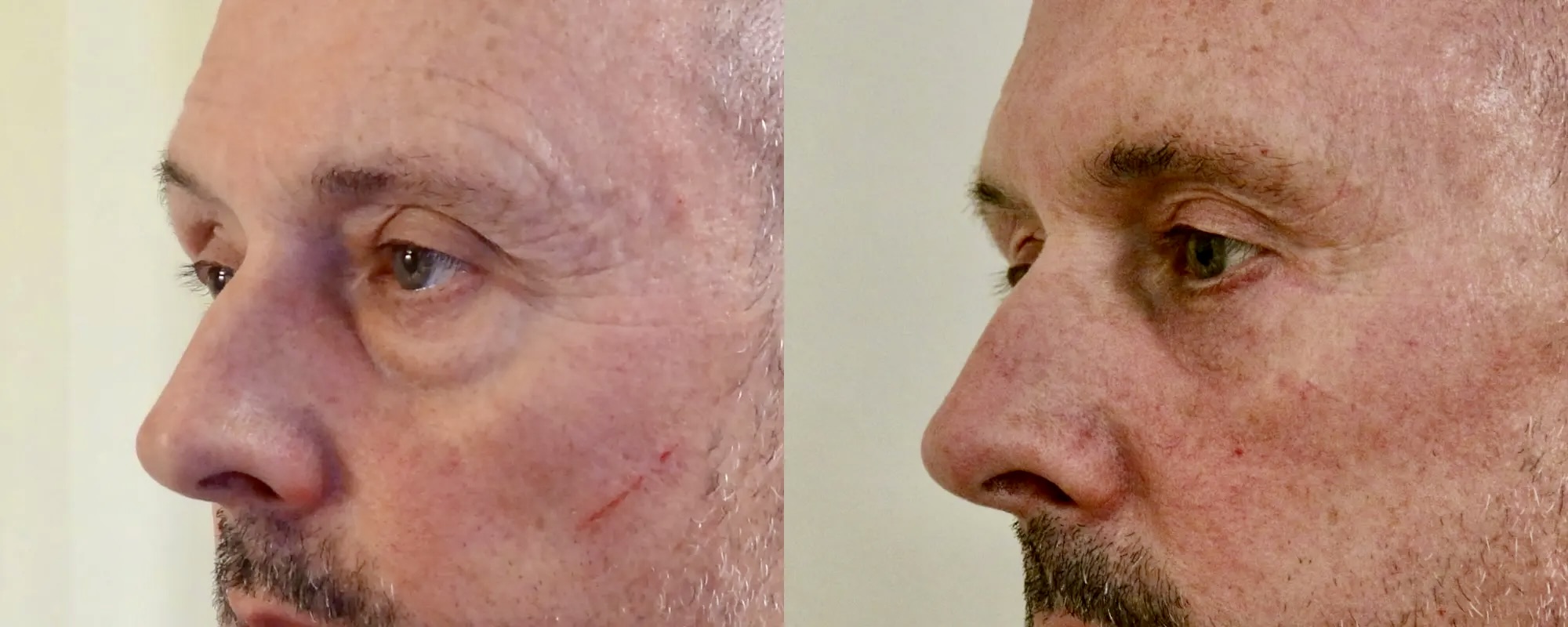 Upper and lower eyelid surgery with fat transfer