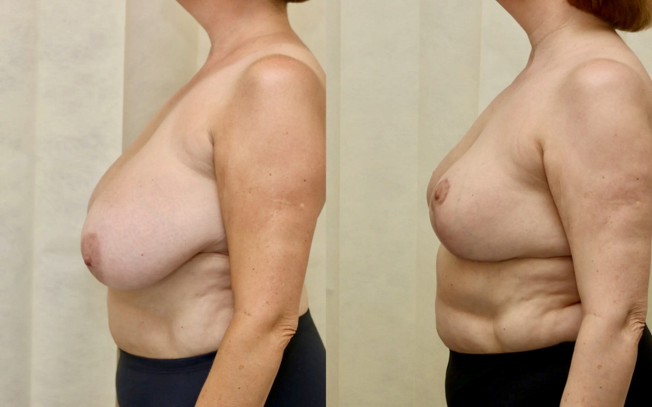long terms after breast reduction