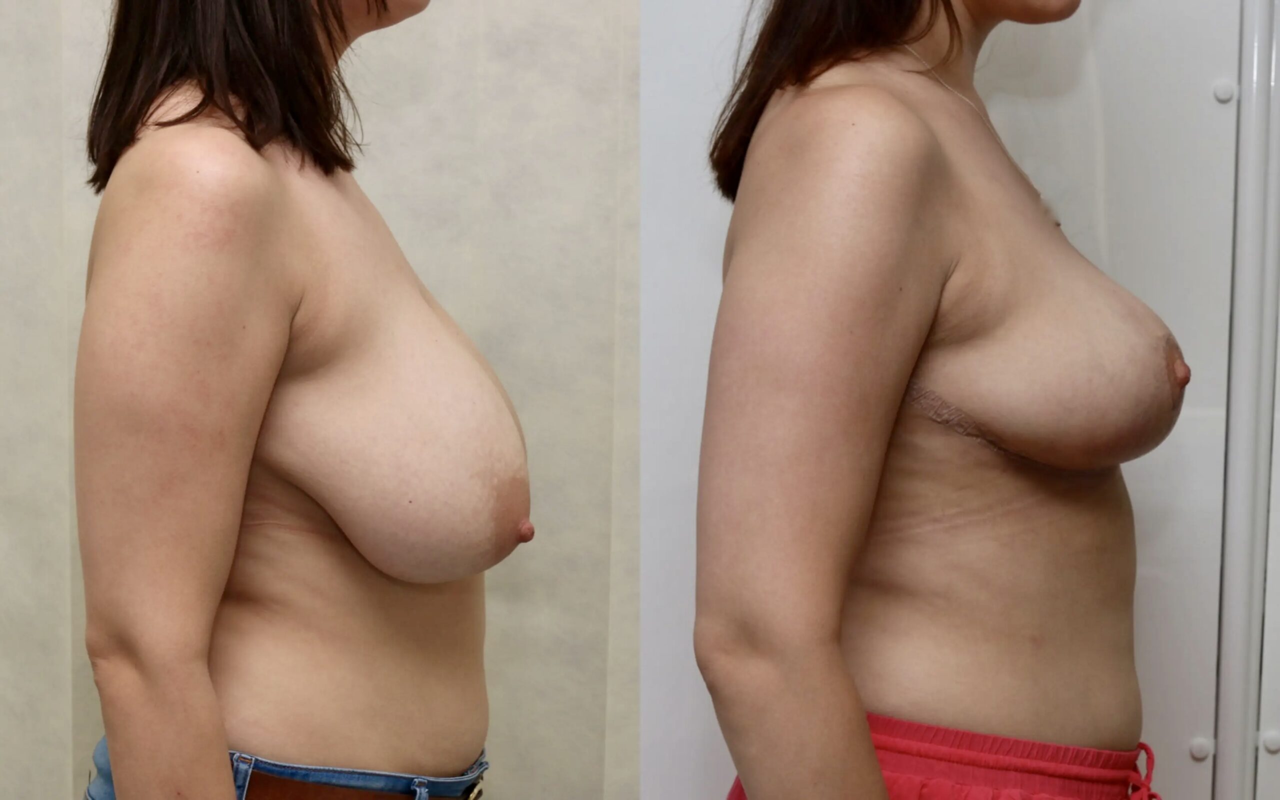 Breast reduction results at four weeks and six months
