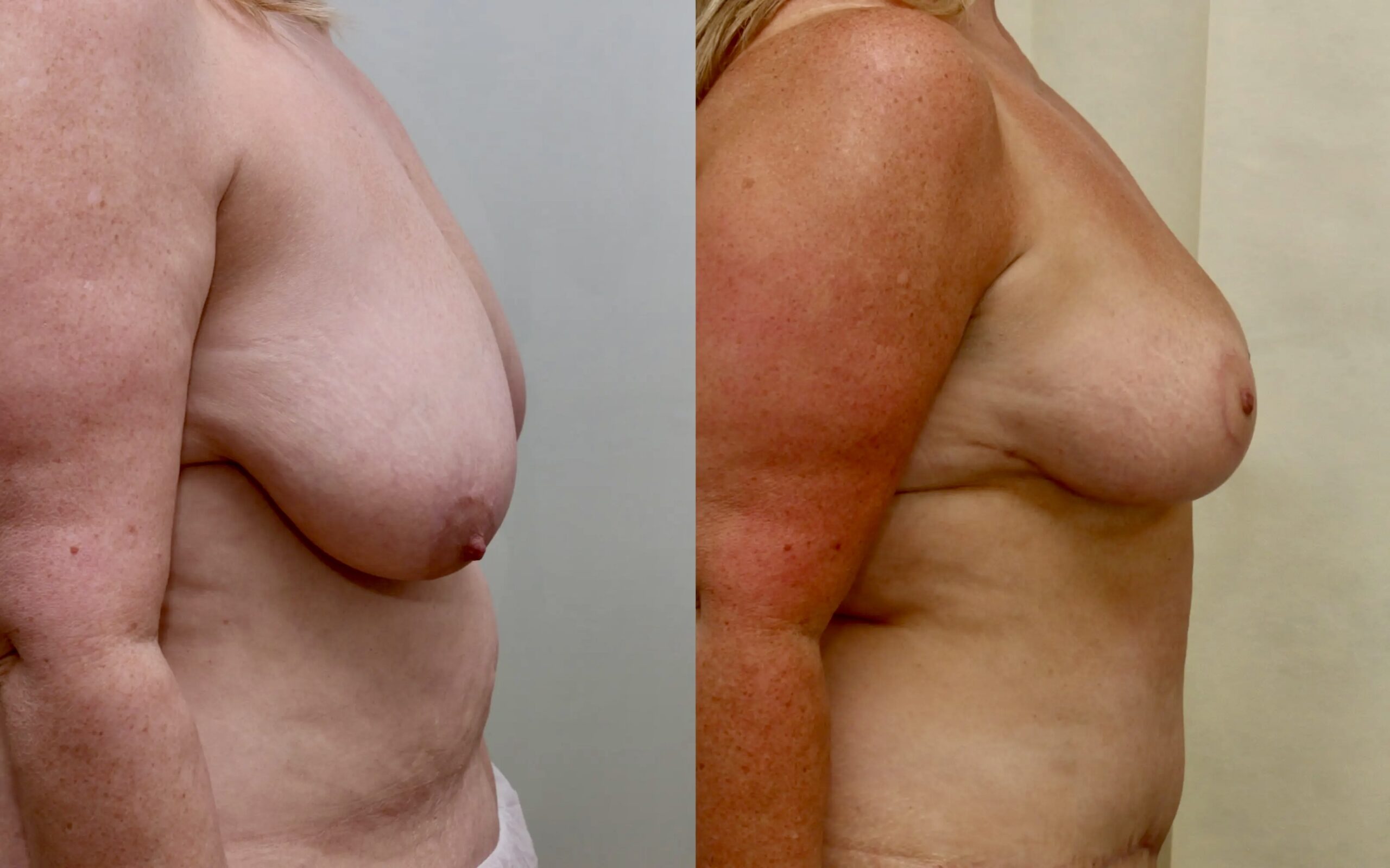 Breast reduction before and after - asymmetry