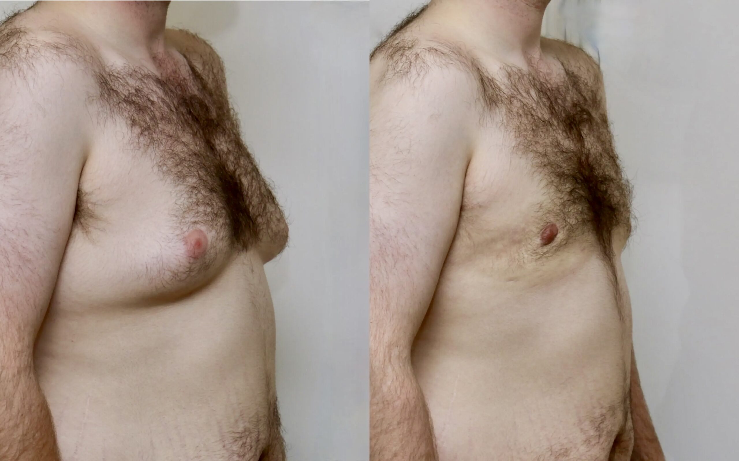 gynaecomastia photos