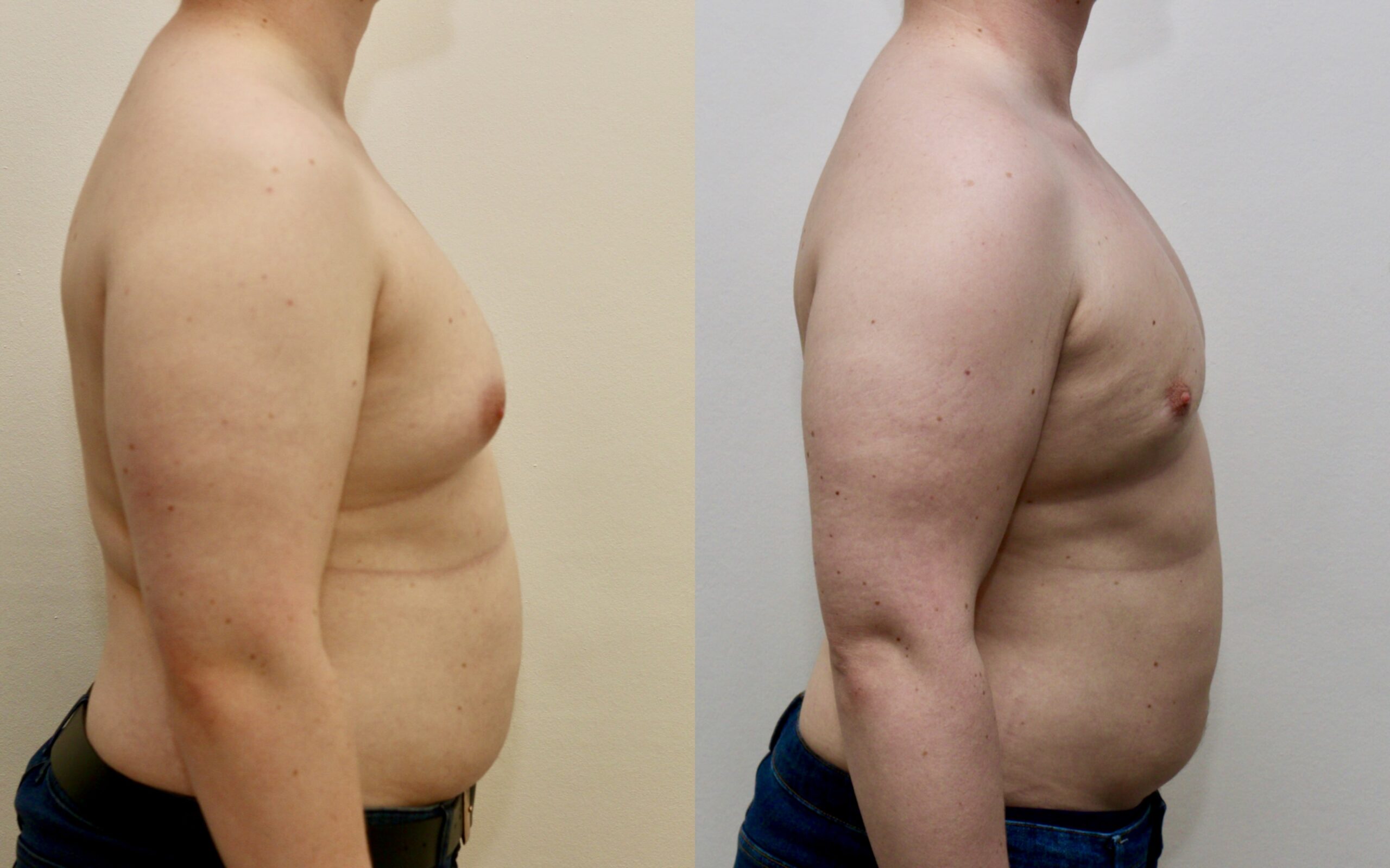 Gynaecomastia before and after