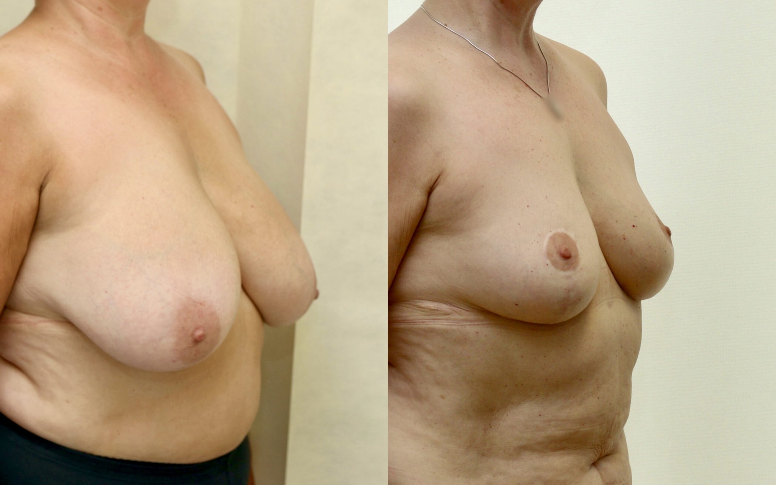 long terms after breast reduction