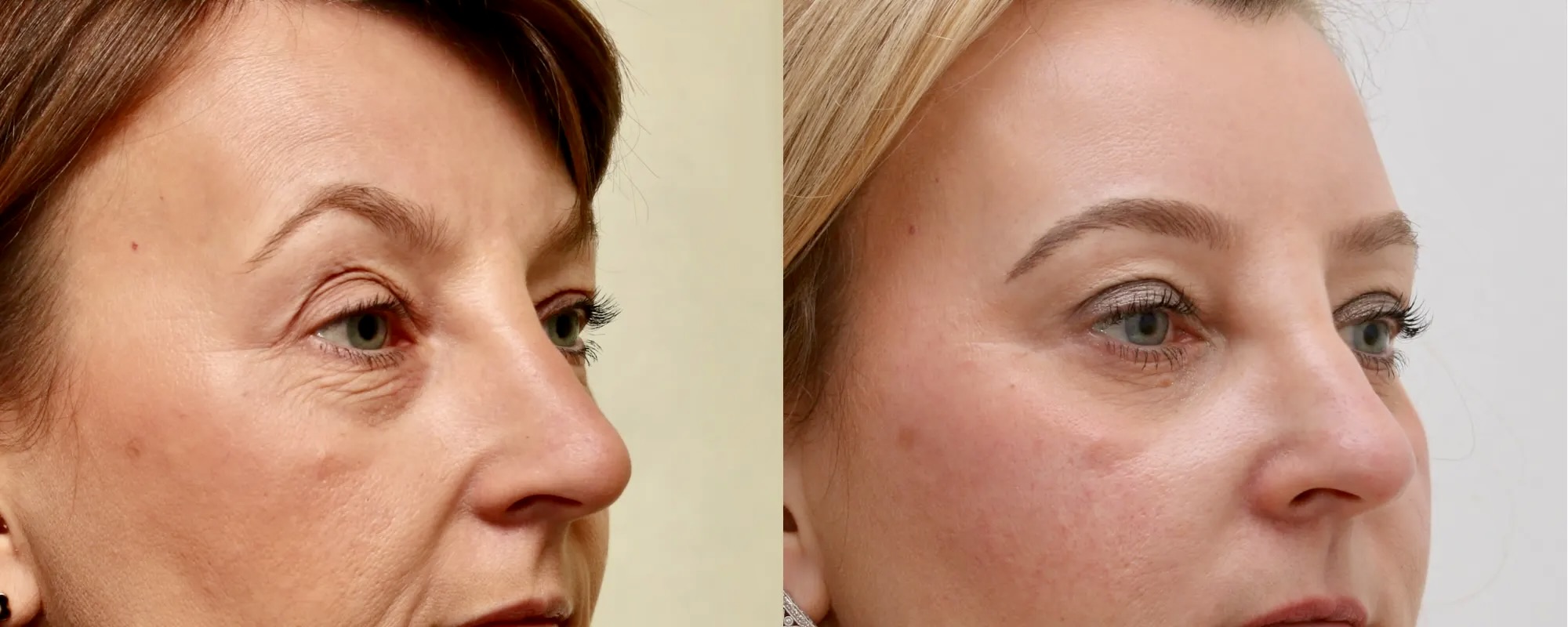 Lower and upper eyelid surgery with fat transfer