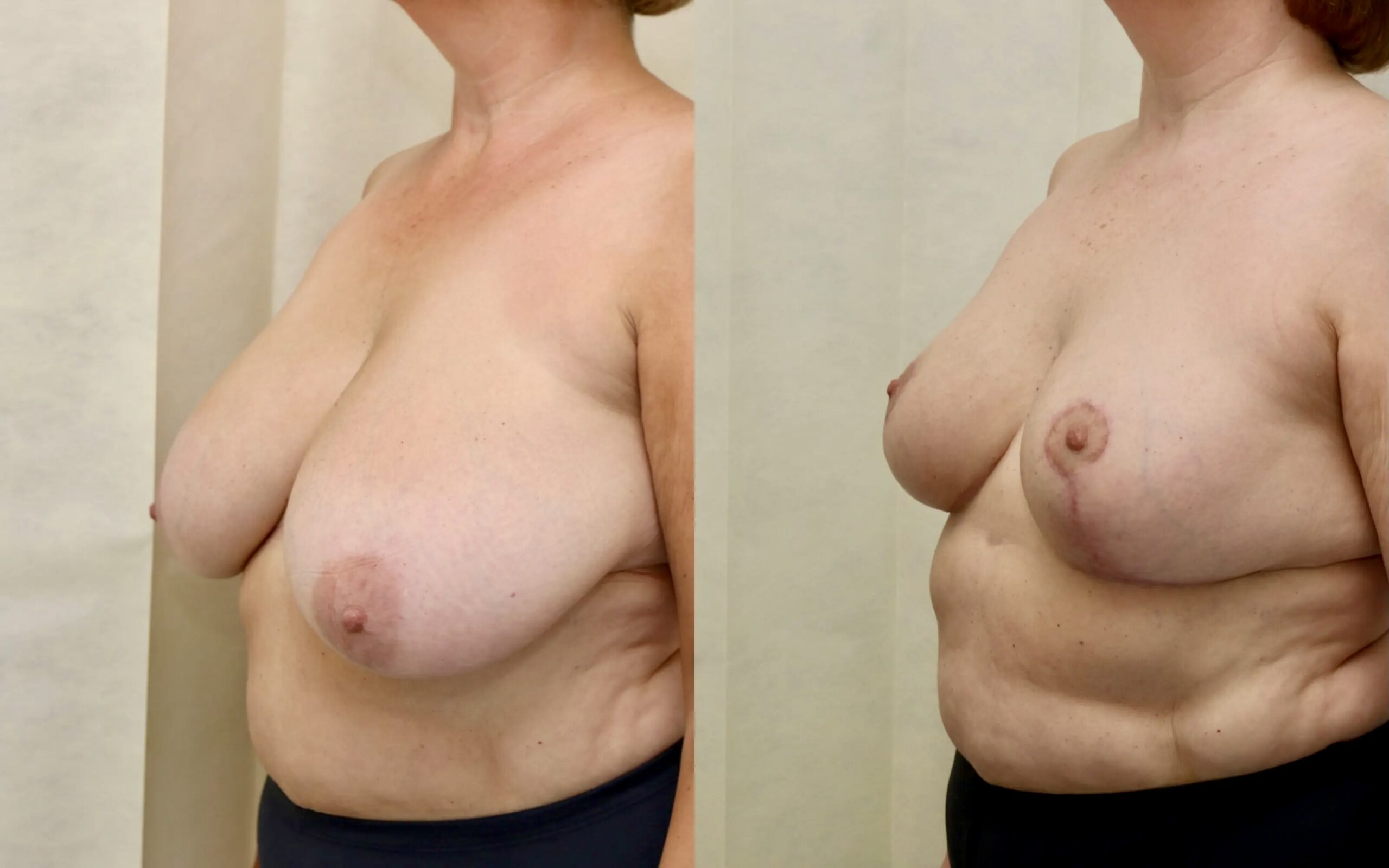 Breast reduction 6 months and 3 years