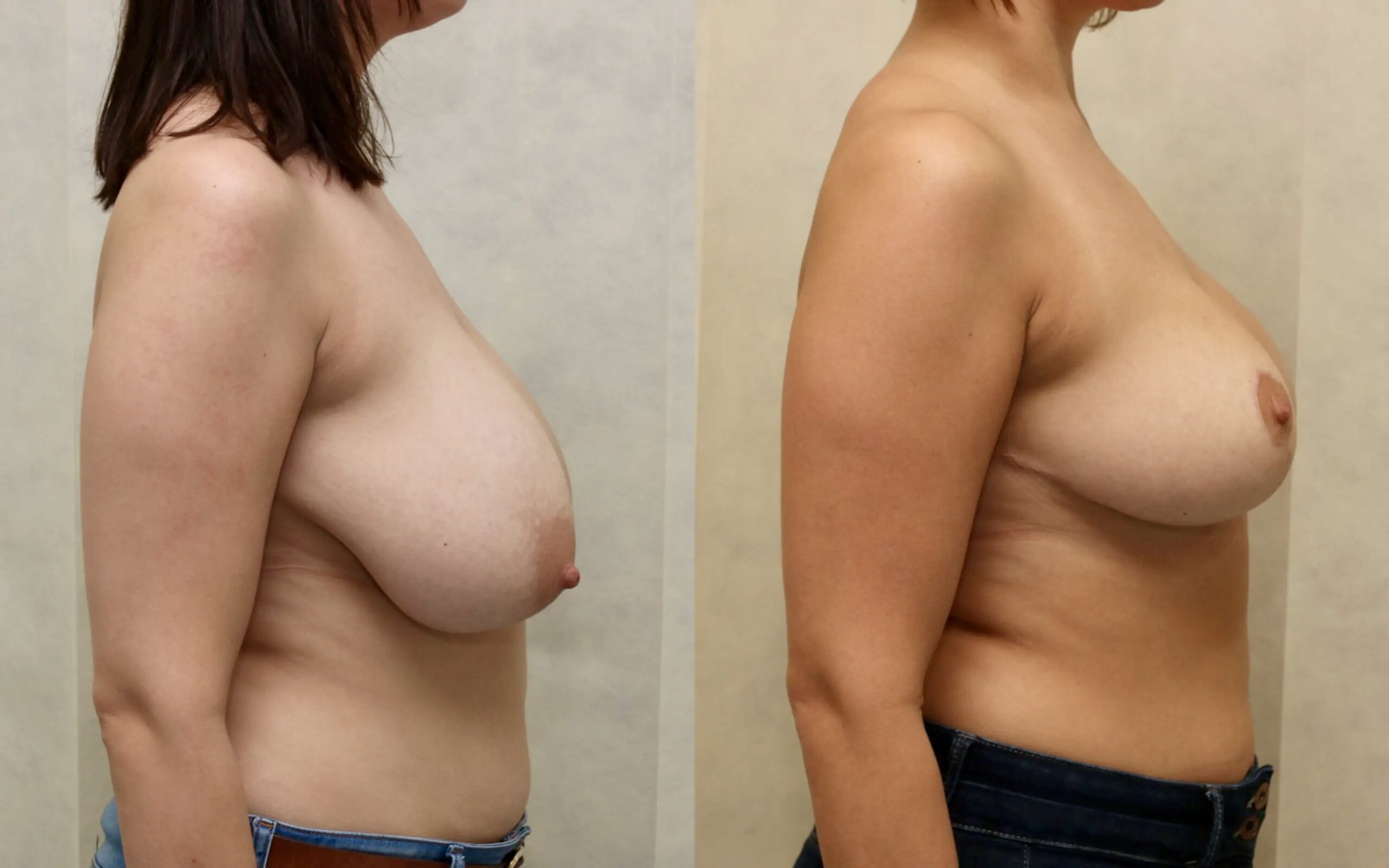 Breast reduction results at four weeks and six months