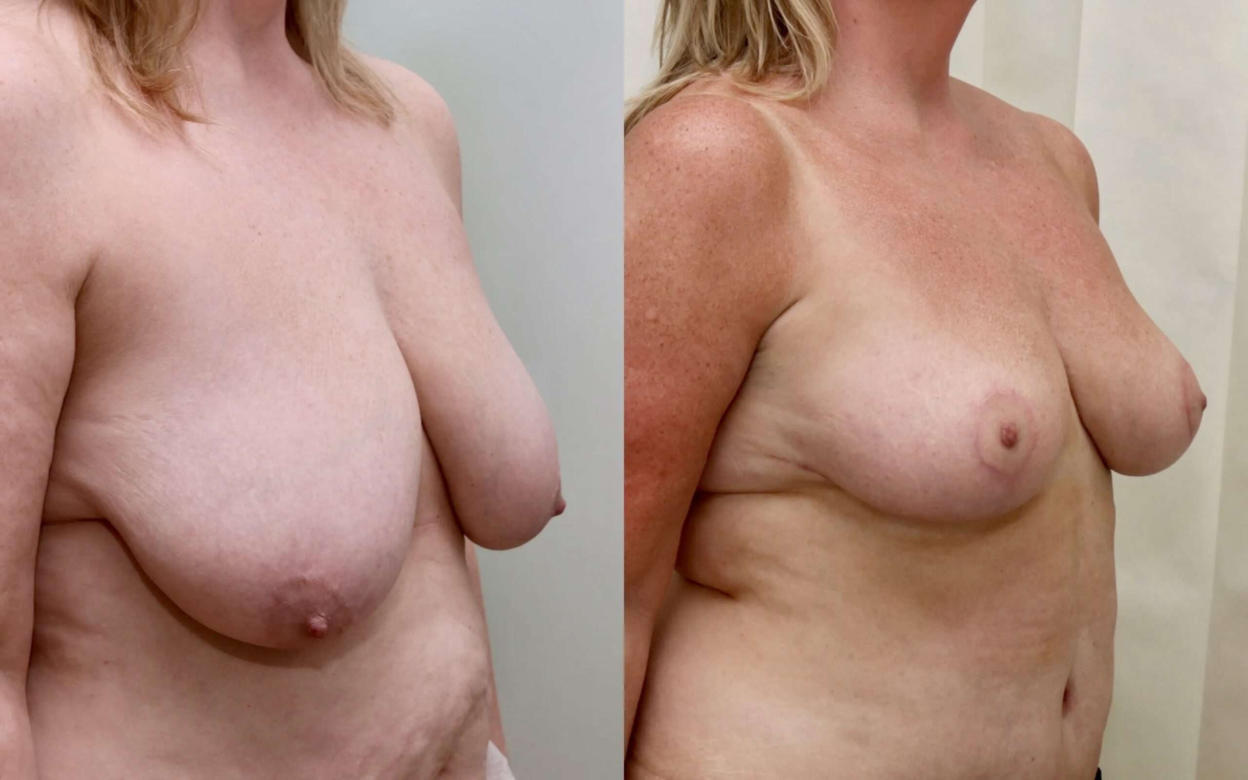 Breast reduction before and after - asymmetry