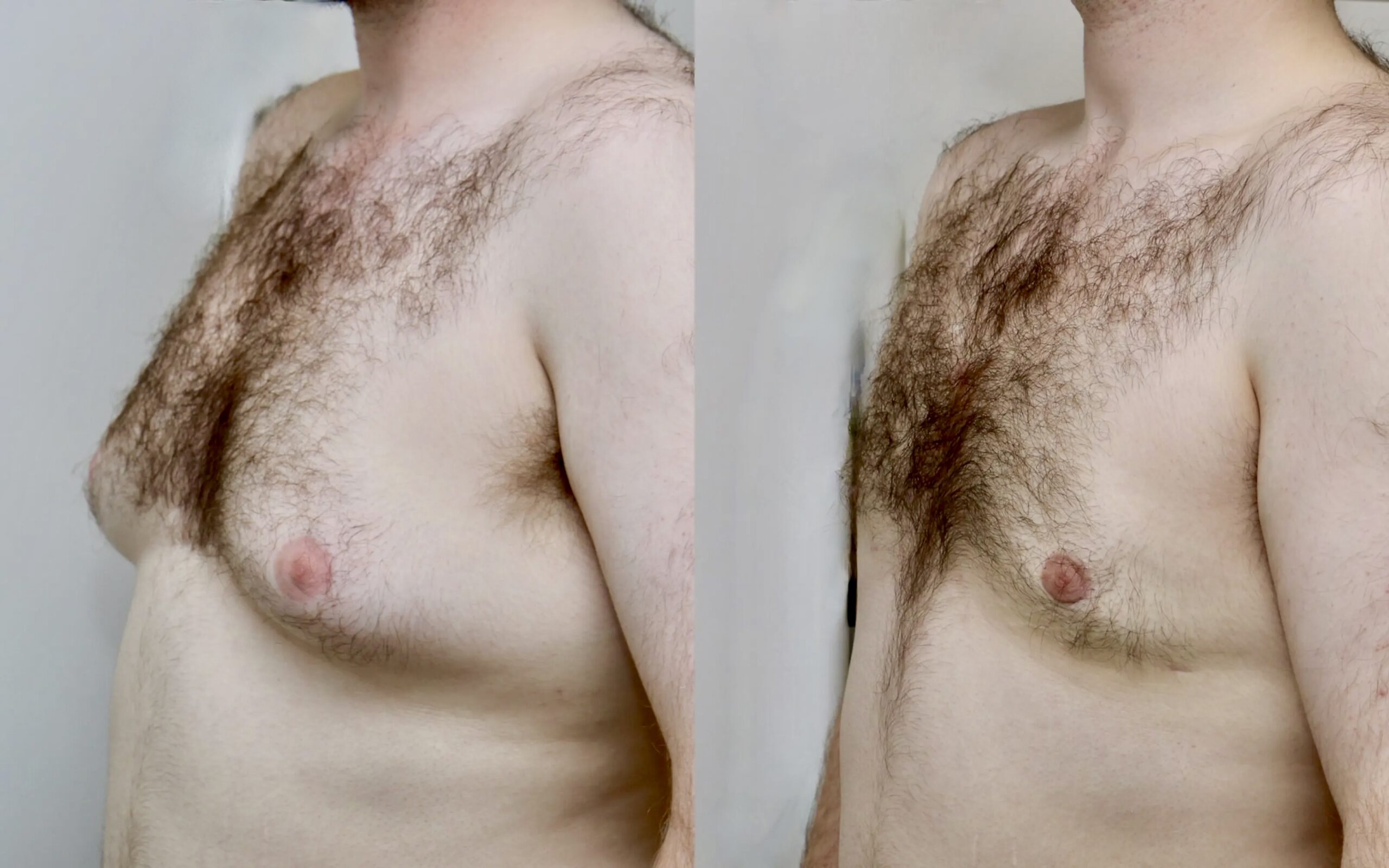 Male breast reduction before and after