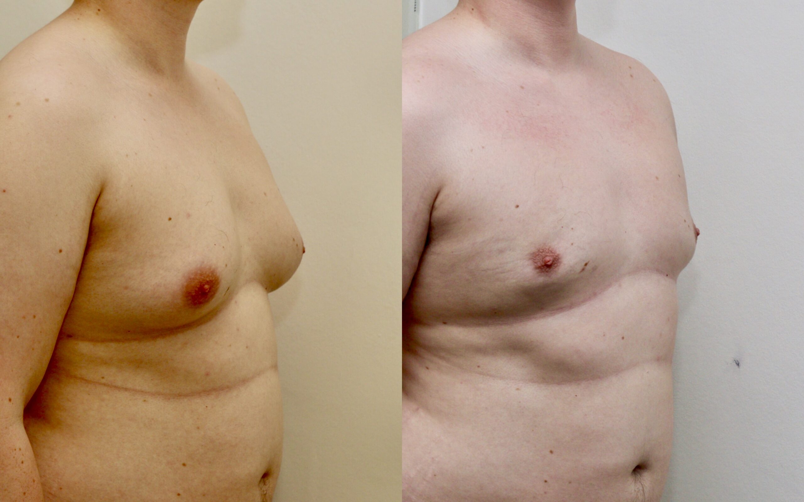 Gynaecomastia before and after