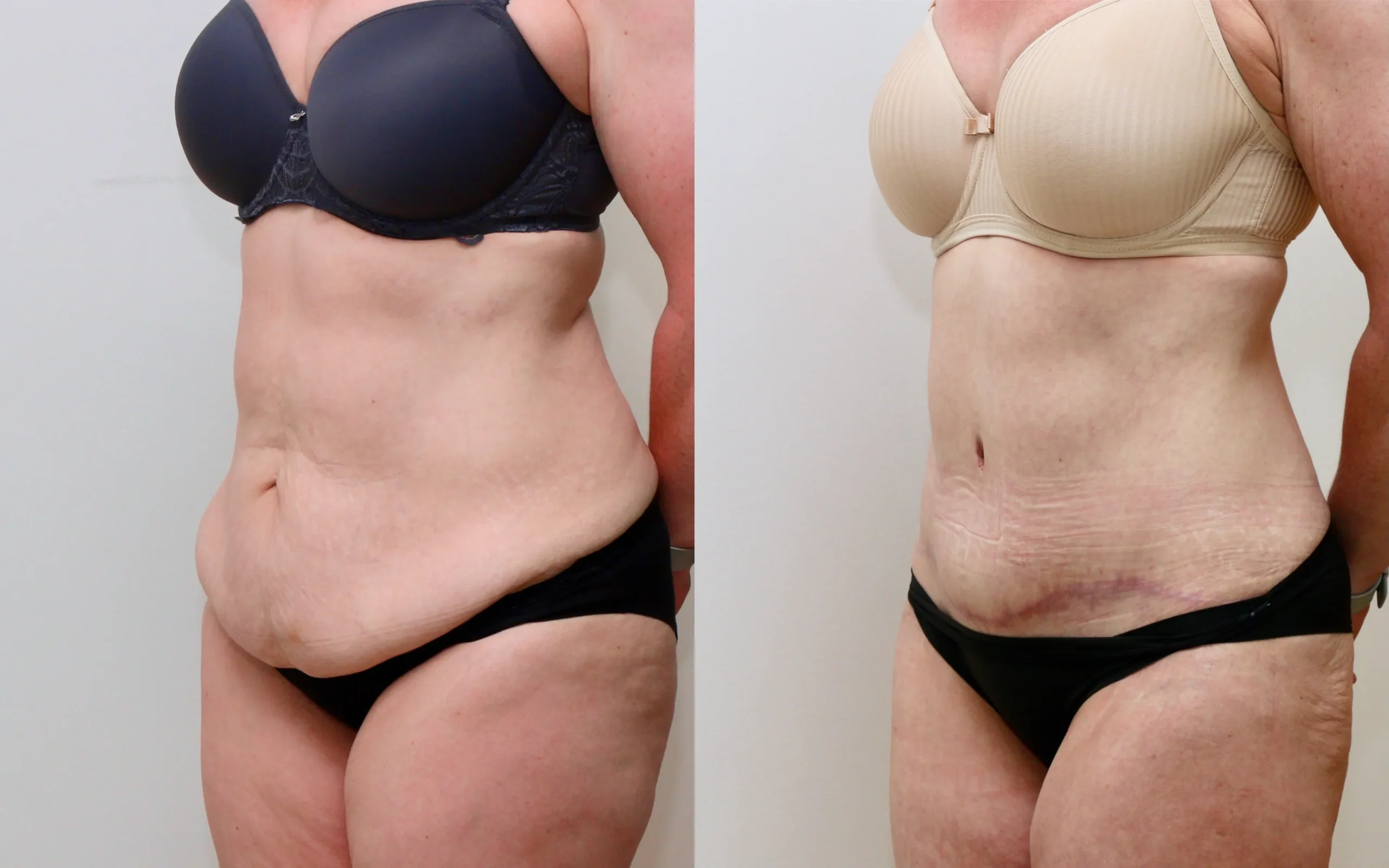 Full tummy tuck