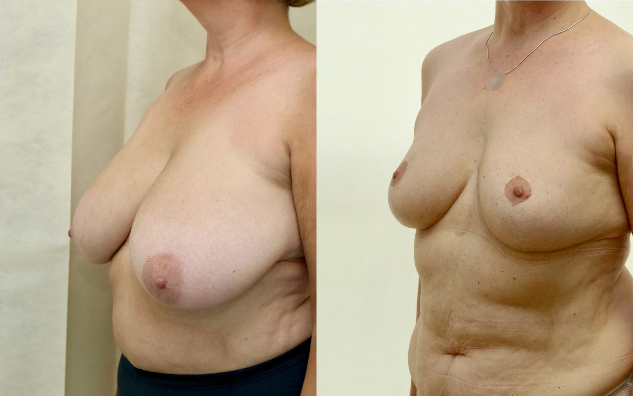 Breast reduction 6 months and 3 years