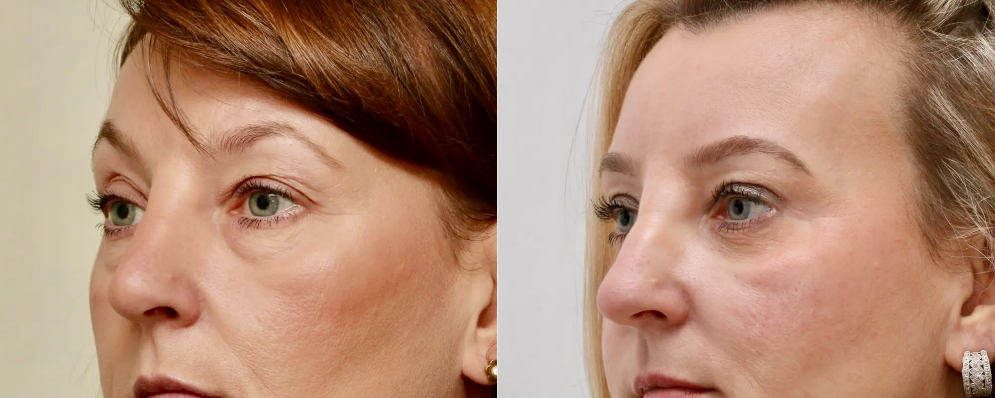 Lower and upper eyelid surgery with fat transfer